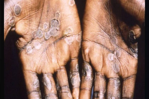 Monkeypox | വാനര വസൂരിയ്‌ക്കെതിരെ സംസ്ഥാനത്ത് ജാഗ്രത; ഈ രോഗത്തെക്കുറിച്ച് അറിയേണ്ടതെല്ലാം