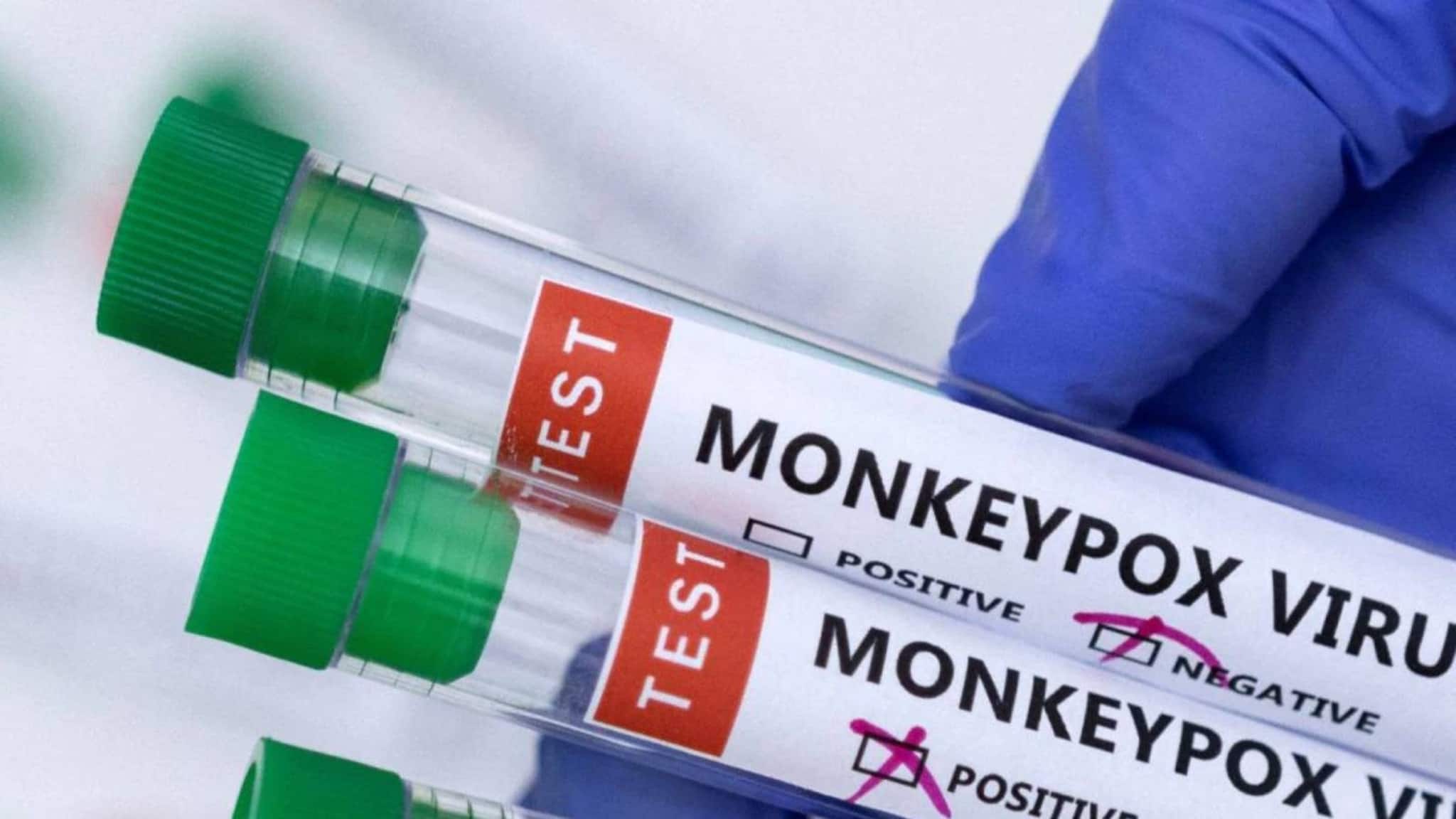 യുവാവിന് ഒരേസമയം മങ്കിപോക്സും എച്ച്ഐവിയും കോവിഡും; എയ്ഡ്സ് പിടിപെട്ടത് ഒരുവർഷത്തിനിടയ്ക്ക്