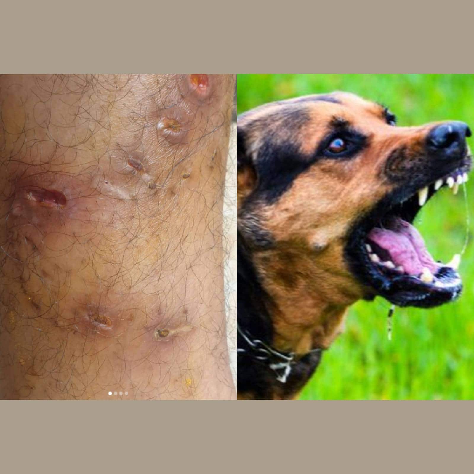Dog bite സിനിമാ നടനെയും പട്ടികടിച്ചു News18 മലയാളം
