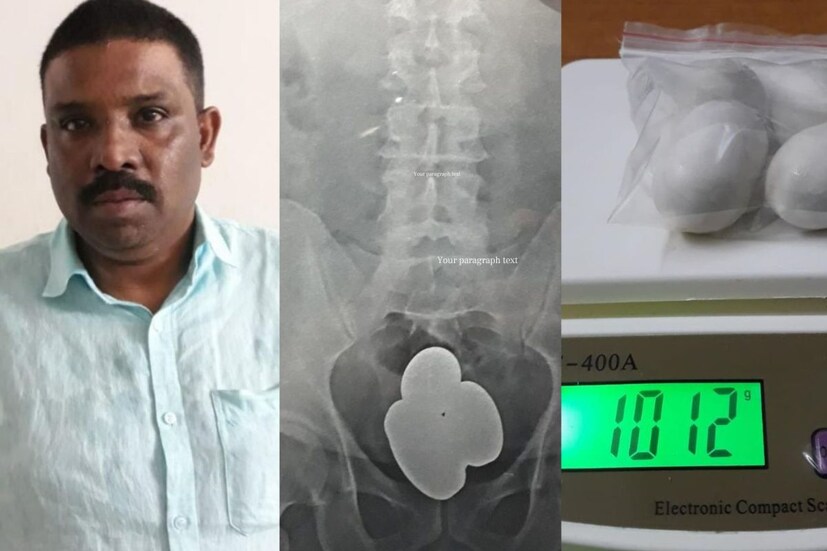  മലപ്പുറം: കരിപ്പൂരിൽ കസ്റ്റംസിൻ്റെ കണ്ണ് വെട്ടിച്ചു പുറത്ത് കടന്നാലും പോലീസിനെ വെട്ടിക്കാൻ കഴിയാത്ത അവസ്ഥയാണ്. ഒരു കിലോയിൽ അധികം സ്വർണവുമായി ജിദ്ദയിൽ നിന്ന്  കരിപ്പൂർ വിമാനത്താവളത്തിലെത്തിയ മലപ്പുറം പട്ടര്‍കടവ്  സ്വദേശി മുഹമ്മദ് ബഷീര്‍ (48) ആണ് സ്വര്‍ണ്ണകടത്തിന്  പിടിയിലായത്. ശരീരത്തിനകത്ത്  കാപ്സ്യൂള്‍ രൂപത്തില്‍ 1.012 കി. ഗ്രാം  സ്വര്‍ണ്ണം മിശ്രിതരൂപത്തില്‍  ഒളിപ്പിച്ച് കടത്താനാണ് ഇയാള്‍ ശ്രമിച്ചത്. ആഭ്യന്തര വിപണിയില്‍ 52 ലക്ഷം രൂപ വില വരും പിടിച്ചെടുത്ത സ്വര്‍ണ്ണത്തിന്.