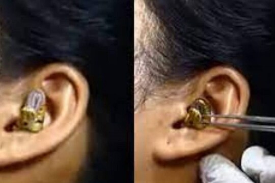 വീഡിയോയിൽ ഡോക്ടർ യുവതിയുടെ ചെവിയിൽ നിന്ന് പാമ്പിനെ പുറത്തെടുക്കാൻ ശ്രമിക്കുന്നത് കാണാം