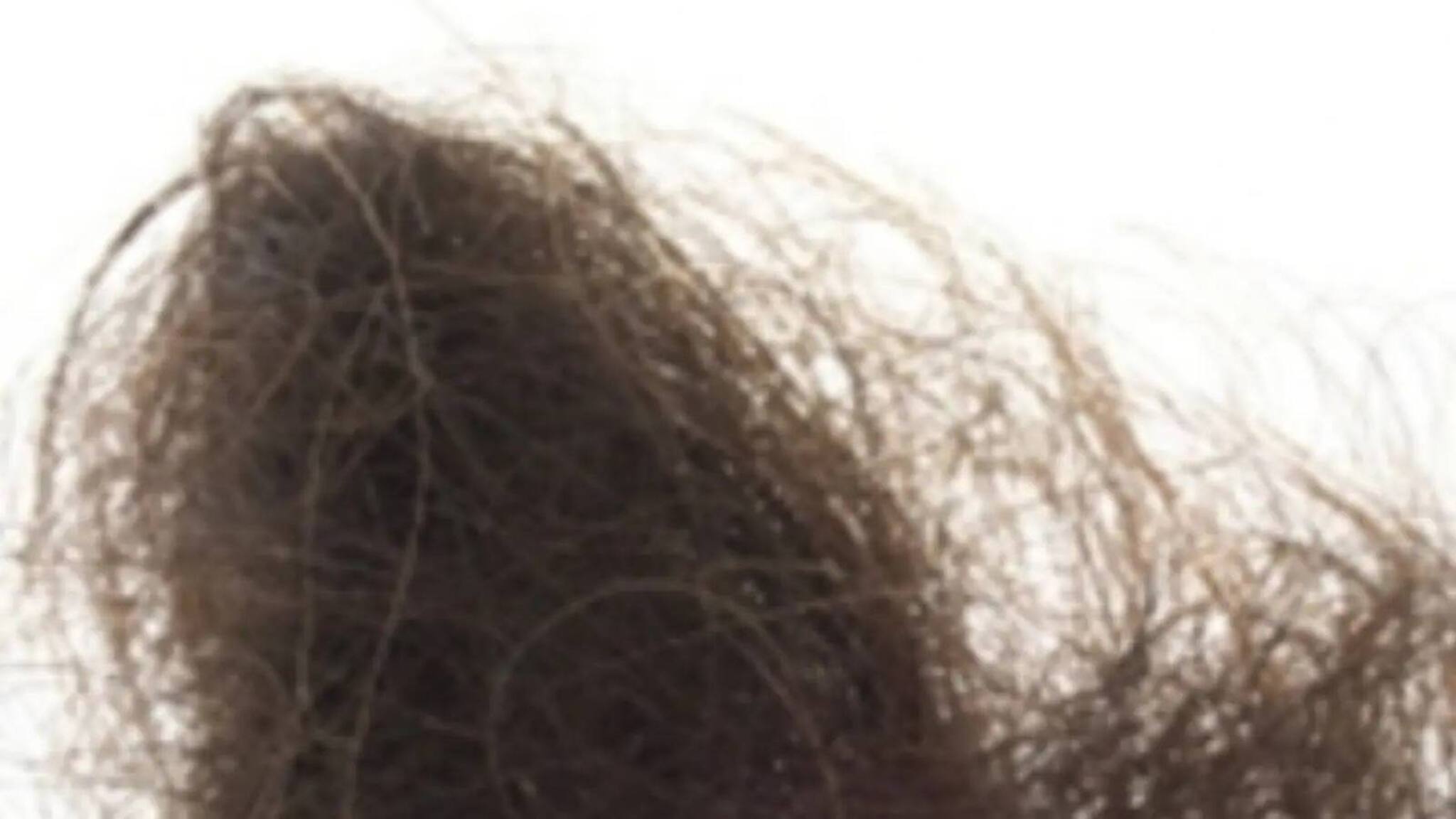 സ്വന്തം തലമുടി തിന്നുന്ന അപൂർവ രോഗം; റാപുന്‍സല്‍ സിന്‍ഡ്രോം മാരകമാകുന്നത് എന്തുകൊണ്ട്?