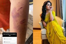 രഞ്ജിനി ഹരിദാസിന് നായ്ക്കളോട് സ്നേഹമാണ്, പക്ഷേ അവർ ചിലപ്പോൾ... അമ്മയുടെ കൈയിലെ മുറിവിന്റെ കഥയുമായി രഞ്ജിനി