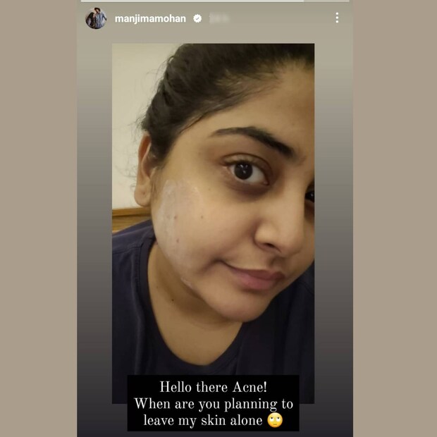  വിഷയം മുഖക്കുരുവാണ്. ഇതെങ്ങനെ ഒന്നൊഴിവാക്കും എന്ന ചിന്തയിൽ നിന്നുമാണ് മഞ്ജിമയുടെ പോസ്റ്റ്