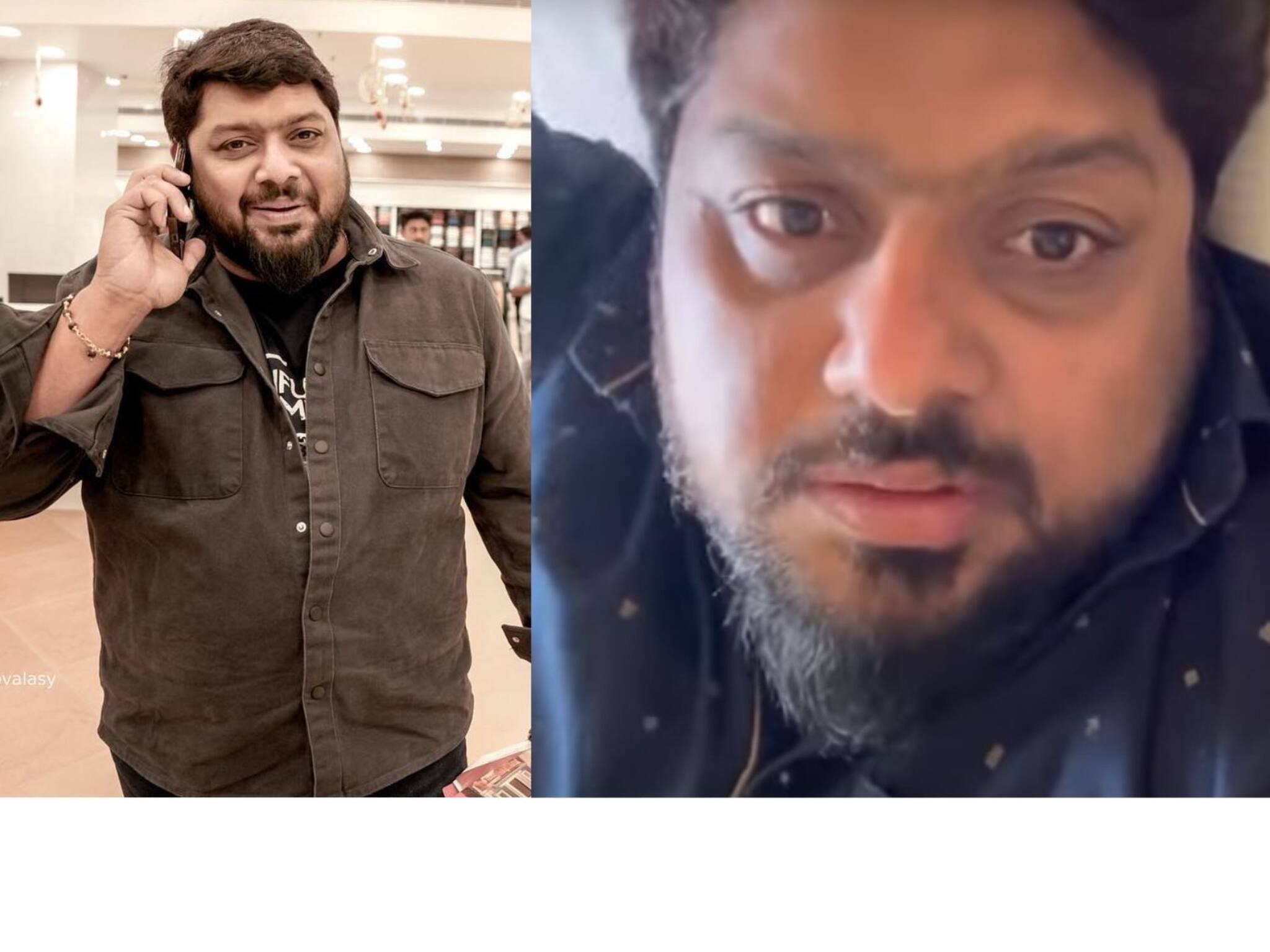 Bell's Palsy| ബെൽസ് പാൾസി; നടൻ മിഥുൻ രമേശ് ആശുപത്രിയില്‍