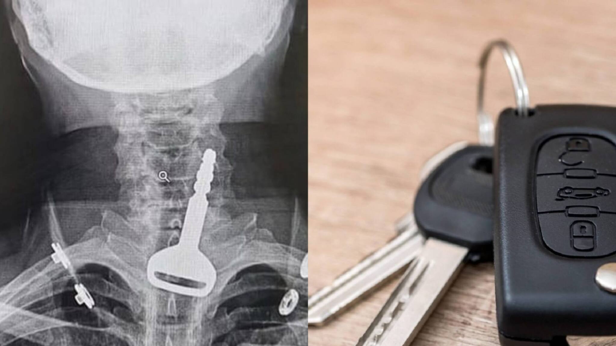 കാറിന്റെ താക്കോൽ 49കാരൻ വിഴുങ്ങി ; ശ്വാസനാളത്തില്‍ നിന്ന് ലാപ്രോസ്‌കോപ്പി വഴി പുറത്തെടുത്തു