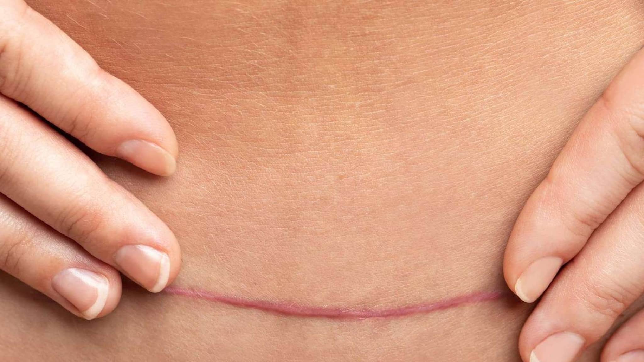 Health Tips | സിസേറിയന് ശേഷമുള്ള പരിചരണം: ശ്രദ്ധിക്കേണ്ട കാര്യങ്ങള്‍