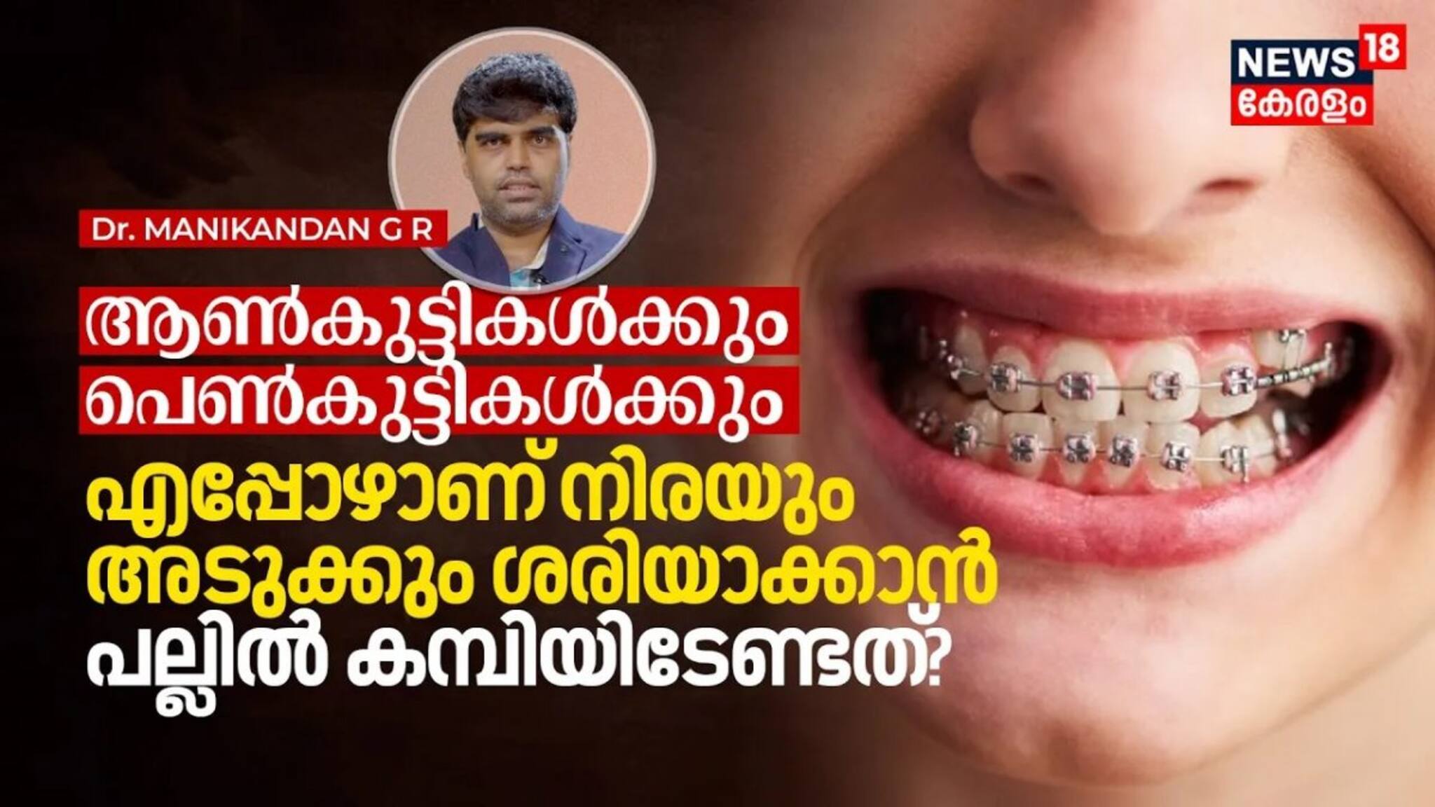 ആൺകുട്ടികൾക്കും പെൺകുട്ടികൾക്കും എപ്പോഴാണ്‌ നിര ശരിയാക്കാൻ പല്ലിൽ കമ്പിയിടേണ്ടത്‌?