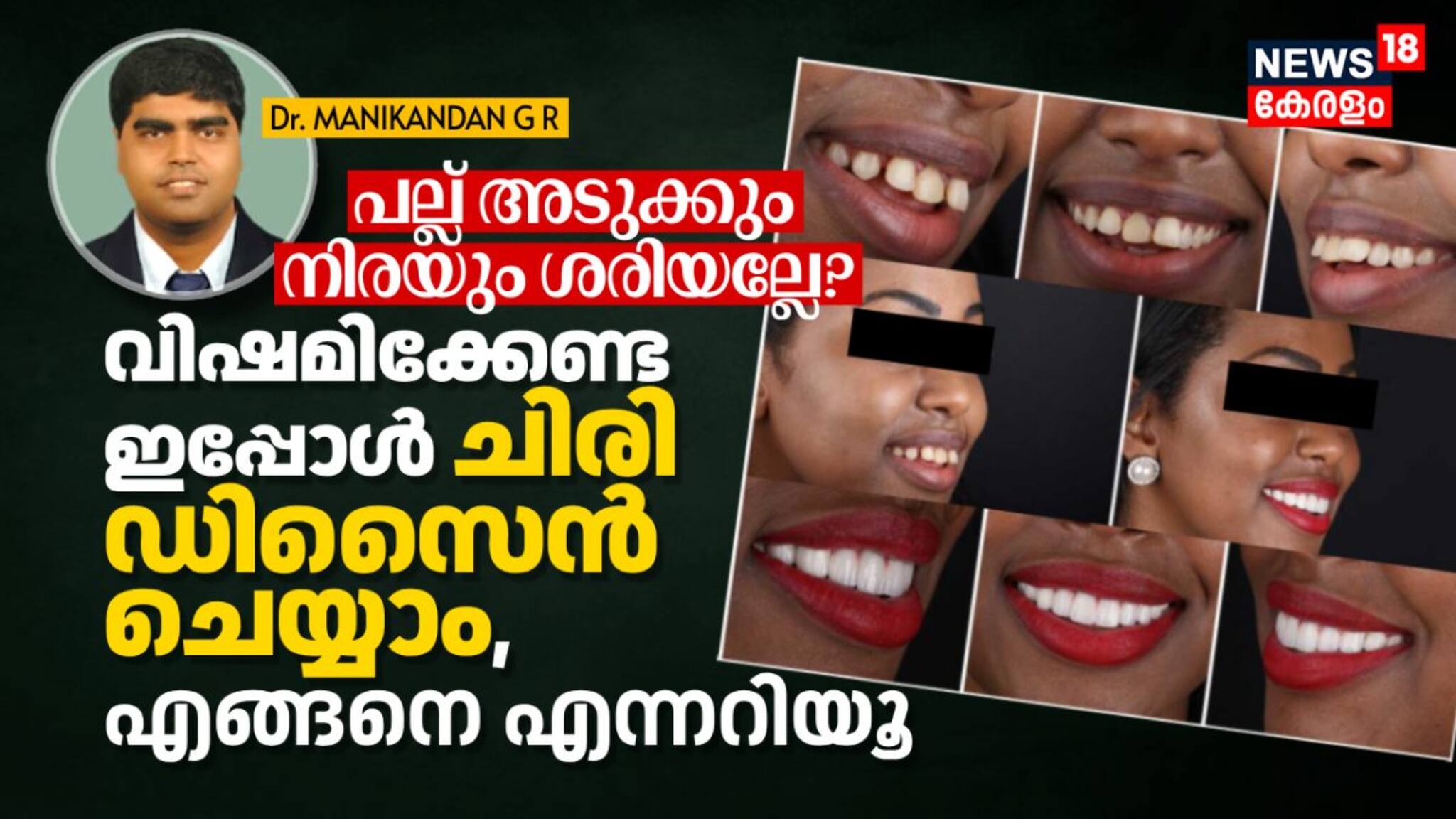 പല്ല് അടുക്കും നിരയും ശരിയല്ലേ? വിഷമിക്കേണ്ട ഇപ്പോൾ ചിരി ഡിസൈൻ ചെയ്യാം, എങ്ങനെ എന്നറിയൂ