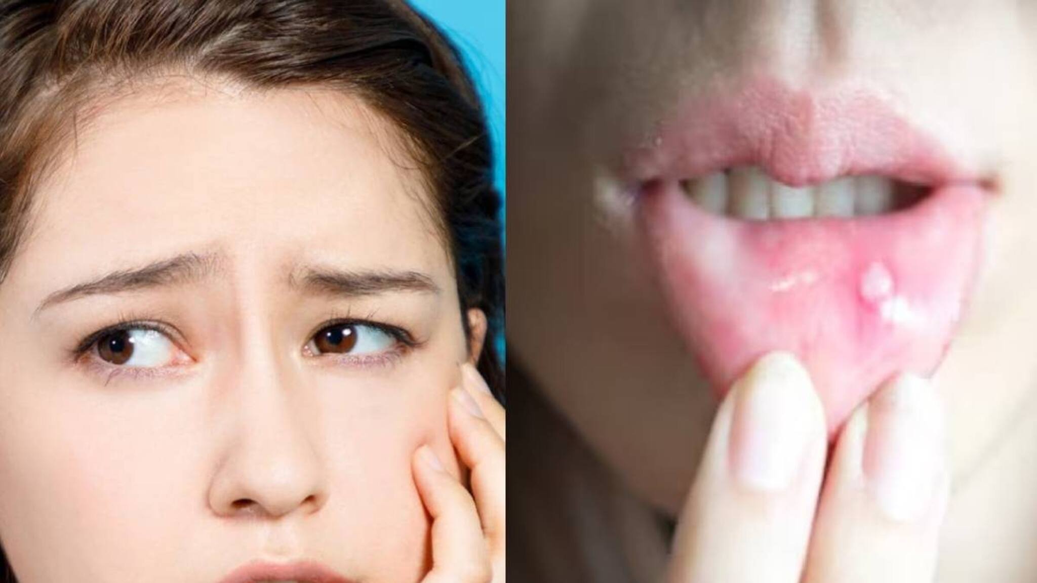 പതിവായി വായ്പ്പുണ്ണ് വരാറുണ്ടോ? നിസാരമാക്കരുത്; ക്രോണ്‍സ് ആന്‍ഡ് സീലിയാക് രോ​ഗലക്ഷണമാകാം