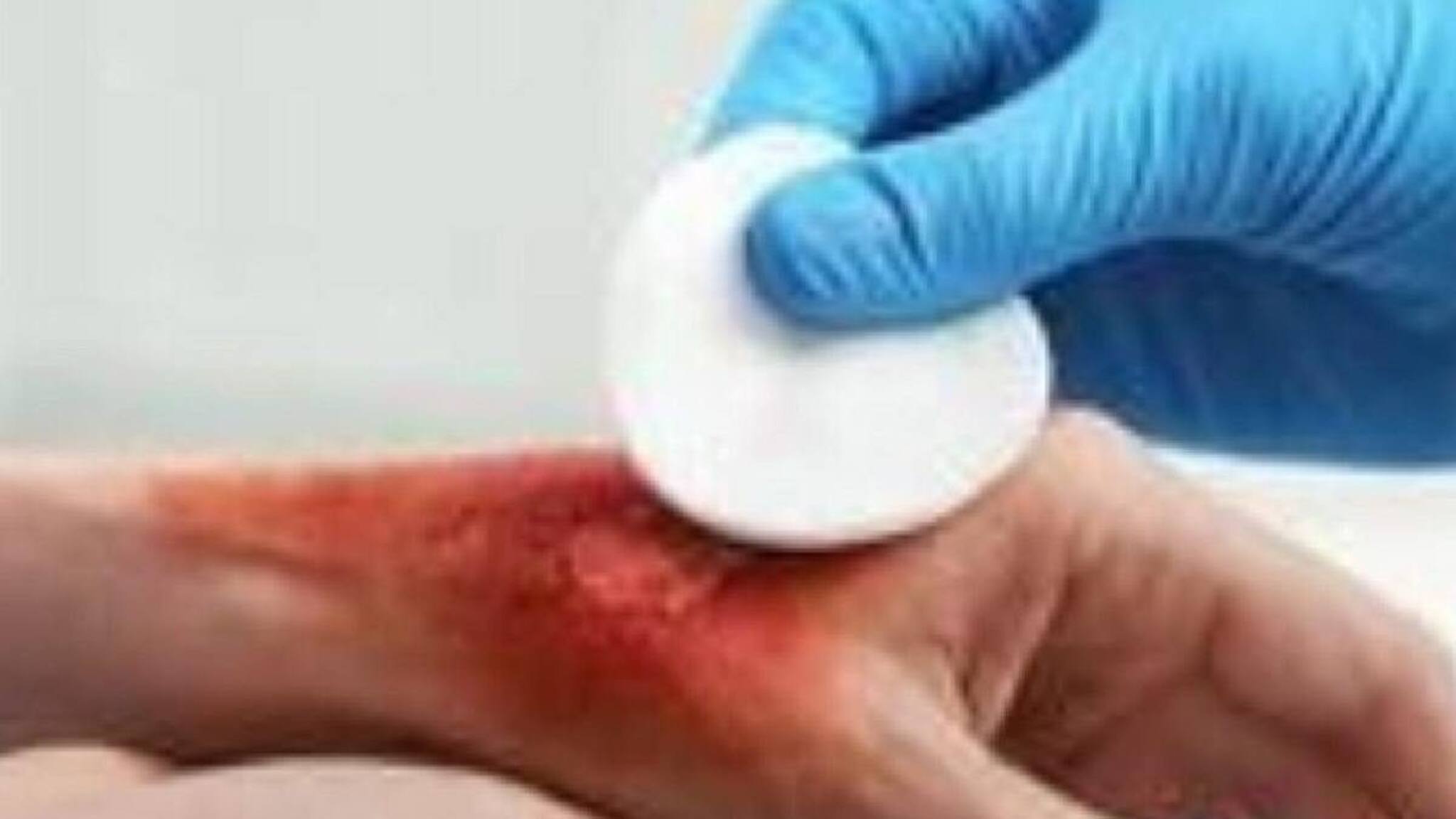 സ്കിൻ ബാങ്ക് ആർക്കൊക്കെ ഗുണമാകും? ചർമം എടുക്കുന്നത് മൃതദേഹത്തിൽ നിന്ന്