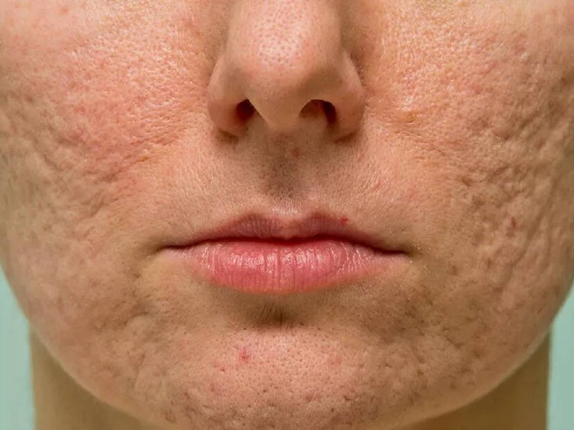Home remedy for pores on face, egg for clear skin , clear skin ,benefits of applying honey on skin,Get Rid Of Your Skin Problems With Honey, honey face pack for skin, honey for skin, skin care , skin care at home ,Face packs for scars, how to treat pores on face, how to close pores, black spots, dark spots, to get rid of black spots, to get rid of dark spots, ‍skin care, products to help acne scars, oily skin face mask, homemade face mask for oily skin, natural remedies for oily skin, reduce acne naturally, honey for acne, turmeric face mask benefits, aloe vera for oily skin, yogurt for acne,  മുഖത്തെ കുഴികൾ എങ്ങനെ മാറ്റാം, ചർമ്മത്തിലെ പാടുകൾ കുറയ്ക്കാൻ, വീട്ടിൽ ചെയ്യാവുന്ന ഫേസ് പായ്ക്ക്, മുഖത്തെ പാടുകൾ അകറ്റാൻ,പാടുകൾ അകറ്റാൻ ഇതാ ഒരു പൊടികൈ, മുഖത്ത് പാടുകളും ചുളിവുകളും മാറ്റാൻ , തേൻ , മുട്ട , ഒലിവ് ഓയിൽ ,ഹെൽത്ത് ന്യൂസ് , സ്കിൻ , ചർമ്മ സംരക്ഷണം 