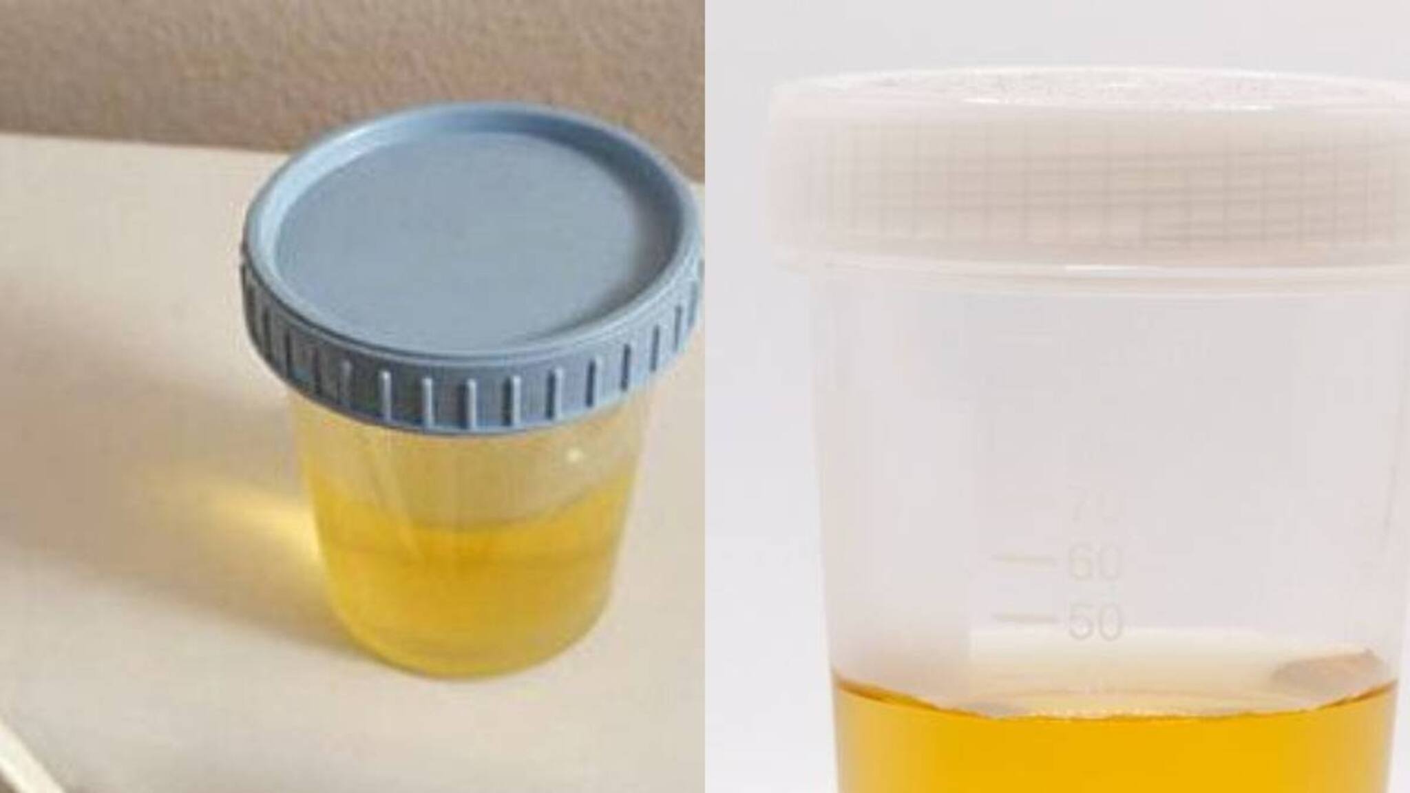 Urine | മൂത്രത്തിൽ ഇങ്ങനെയൊരു ലക്ഷണം ഉണ്ടോന്നു നോക്കൂ; എങ്കിൽ വേഗം ഡോക്‌ടറെ കണ്ട് പരിഹാരം തേടൂ