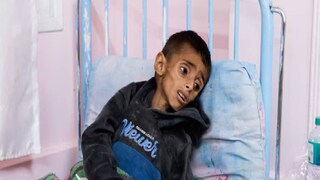 തെക്കൻ ഗാസ മുനമ്പിലെ ഖാൻ യൂനിസിലെ നാസർ ആശുപത്രിയിൽ ചികിത്സയിൽ കഴിയുന്ന 5 വയസ്സുള്ള പലസ്ഥീൻ ബാലൻ ഒസാമ അൽ-റെഖെപ് (ചിത്രം: REUTERS)