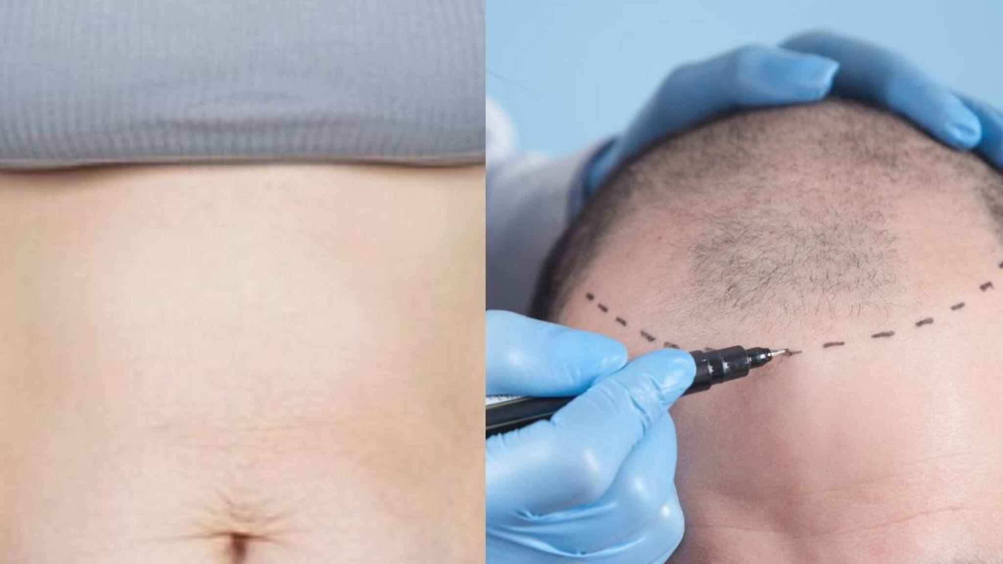 സൗന്ദര്യം വർധിപ്പിക്കാൻ അടിവയറ്റിലെ കൊഴുപ്പ് നീക്കാനും തലയിൽ മുടി വെച്ചു പിടിപ്പിക്കാനും പോകുന്നവരുടെ പ്രത്യേക ശ്രദ്ധയ്ക്ക്