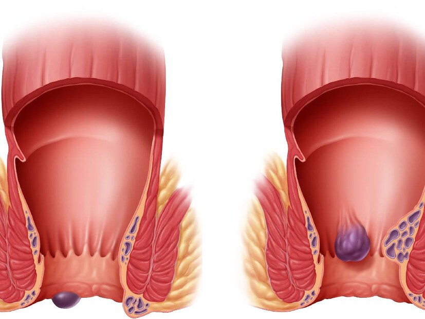 piles symptoms, piles signs, early symptoms of piles, early signs of piles, Haemorrhoids, constipation, Piles symptom, Piles treatment, Piles causes, Lifestyle, Health and fitness, Smartphones, Bathroom, lifestyle, lifestyle news, piles, piles, what is piles, piles causes, piles symptoms, what are signs of piles, how to detect piles, piles treatment, piles prevention, how to prevent piles, treatment of piles in Malayalam , piles causes in Malayalam , how long do piles last, is walking good for piles, can piles be cured permanently, What are the first stages of piles? Know the early sign and symptoms of piles, Piles Diagnosis and Treatment, piles symptoms, piles cure, piles symptoms in Malayalam , what is hemorrhoids, is hemorrhoids piles same, how to treat hemorrhoids, hemorrhoids best treatment, piles images, piles symptoms, piles treatment, piles medicine, piles ointment, hemorrhoids piles symptoms causes and treatment, പൈൽസ് , മൂലക്കുരു,ഹെമറോയ്ഡുകൾ ,പൈൽസ് ലക്ഷണങ്ങൾ ,മൂലക്കുരു ലക്ഷണങ്ങൾ ,മലവിസർജ്ജന ,മലബന്ധം ,മൂലക്കുരു പ്രാരംഭ ഘട്ടത്തിൽ, മൂലക്കുരു ചികിത്സ , പൈൽസ് ചികിത്സ , മലദ്വാരം, ഗർഭിണികളിലും പൈൽസ്,ഇന്റേണൽ പൈൽസും ,എക്സ്റ്റേണൽ പൈൽസും,വയറിളക്കം, വാർദ്ധക്യം, ടോയ്‌ലറ്റിൽ ദീർഘനേരം ഇരിക്കുന്നത്, തുടർച്ചയായ ചുമ, ഭാരമുള്ള വസ്തുക്കൾ,മലവിസര്‍ജനം ,ഹെൽത്ത് , ഹെൽത്ത് ന്യൂസ്