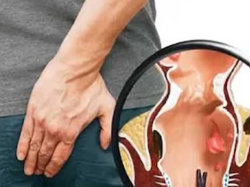 piles symptoms, piles signs, early symptoms of piles, early signs of piles, Haemorrhoids, constipation, Piles symptom, Piles treatment, Piles causes, Lifestyle, Health and fitness, Smartphones, Bathroom, lifestyle, lifestyle news, piles, piles, what is piles, piles causes, piles symptoms, what are signs of piles, how to detect piles, piles treatment, piles prevention, how to prevent piles, treatment of piles in Malayalam , piles causes in Malayalam , how long do piles last, is walking good for piles, can piles be cured permanently, What are the first stages of piles? Know the early sign and symptoms of piles, Piles Diagnosis and Treatment, piles symptoms, piles cure, piles symptoms in Malayalam , what is hemorrhoids, is hemorrhoids piles same, how to treat hemorrhoids, hemorrhoids best treatment, piles images, piles symptoms, piles treatment, piles medicine, piles ointment, hemorrhoids piles symptoms causes and treatment, പൈൽസ് , മൂലക്കുരു,ഹെമറോയ്ഡുകൾ ,പൈൽസ് ലക്ഷണങ്ങൾ ,മൂലക്കുരു ലക്ഷണങ്ങൾ ,മലവിസർജ്ജന ,മലബന്ധം ,മൂലക്കുരു പ്രാരംഭ ഘട്ടത്തിൽ, മൂലക്കുരു ചികിത്സ , പൈൽസ് ചികിത്സ , മലദ്വാരം, ഗർഭിണികളിലും പൈൽസ്,ഇന്റേണൽ പൈൽസും ,എക്സ്റ്റേണൽ പൈൽസും,വയറിളക്കം, വാർദ്ധക്യം, ടോയ്‌ലറ്റിൽ ദീർഘനേരം ഇരിക്കുന്നത്, തുടർച്ചയായ ചുമ, ഭാരമുള്ള വസ്തുക്കൾ,മലവിസര്‍ജനം ,ഹെൽത്ത് , ഹെൽത്ത് ന്യൂസ്