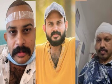 വിജയ് മാധവ് (ഇടത്) ഹെയർ ട്രാൻസ്പ്ലാന്റേഷൻ നടത്തി തലയോട്ടിയിൽ അണുബാധയുണ്ടായ സനിൽ (വലത്)
