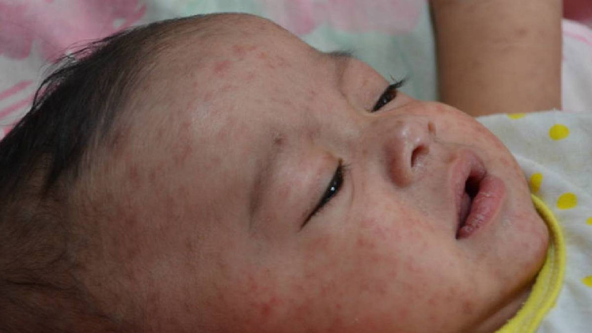 Measles: നിങ്ങളുടെ കുഞ്ഞിന് വിട്ടുമാറാത്ത പനിയും ജലദോഷവും ഉണ്ടോ? അഞ്ചാം പനി നിസാരക്കാരനല്ല