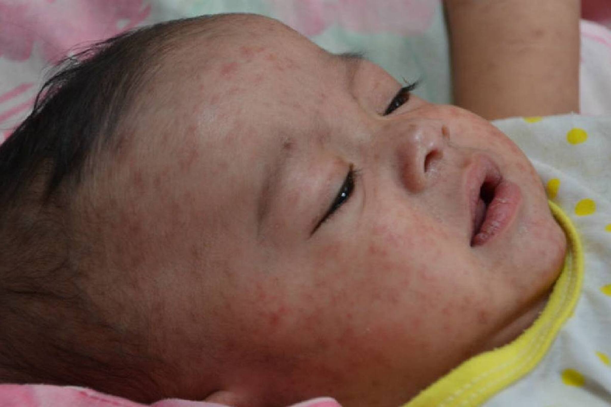 Measles: നിങ്ങളുടെ കുഞ്ഞിന് വിട്ടുമാറാത്ത പനിയും ജലദോഷവും ഉണ്ടോ? അഞ്ചാം പനി നിസാരക്കാരനല്ല