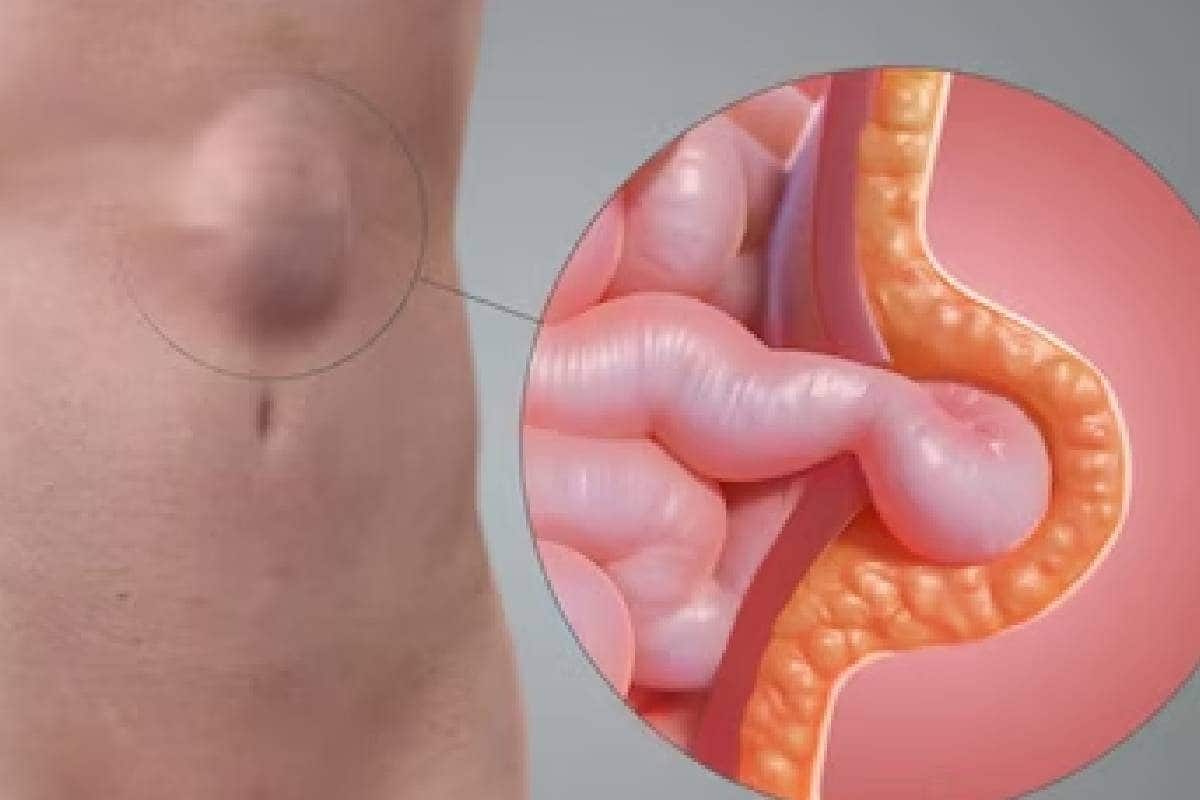 Hernia: തുടർച്ചയായ വയറുവേദനയും മലബന്ധവും അനുഭവപ്പെടാറുണ്ടോ? ശരീരം തരുന്ന ഈ ലക്ഷണങ്ങൾ നിസ്സാരമാക്കരുത്!!
