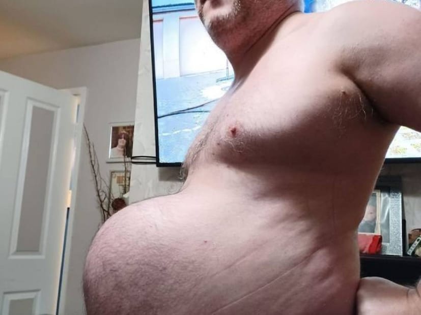 hernia, Types of hernia , hernia symptoms, hernia Causes ,hernia Treatment, Inguinal hernia, Femoral hernia, Umbilical hernia, Epigastric hernia, Diaphragmatic hernia, hernia, Gastroenterology, Type of hernia, hernia symptoms, hernia causes, hernia treatment, hernia treatment, colon health, health, Hernia, Inguinal Hernia, Neeraj Chopra, Hernia Treatment, Hernia Symptoms, ഹെർണിയ, ഹെർണിയ കരണങ്ങൾ , ഹെർണിയ ലക്ഷണങ്ങൾ , ഹെർണിയ ചികിത്സ ,ഹെർണിയ ശസ്ത്രക്രിയ ,ഹെർണിയ ഹോസ്പിറ്റൽ ,വയറുവേദന, മലബന്ധവും, കുടൽ രോഗങ്ങൾ , ഇൻജുവൈനൽ ഹെർണിയ, ഫെമറൽ ഹെർണിയ, പൊക്കിൾ ഹെർണിയ, ഇൻസിഷണൽ ഹെർണിയ, എപ്പിഗാസ്ട്രിക് ഹെർണിയ, ഡയഫ്രാമാറ്റിക് ഹെർണിയ ,പേശി ഹെർണിയ, ഹെൽത്ത് ന്യൂസ് 