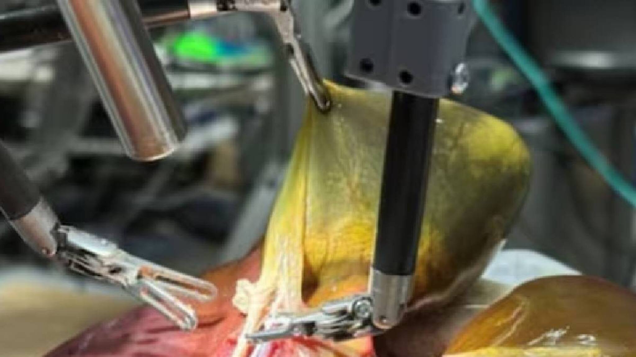 AI റോബോട്ട് പിത്താശയം മാറ്റിവെച്ചു; ശസ്തക്രിയ വിജയം