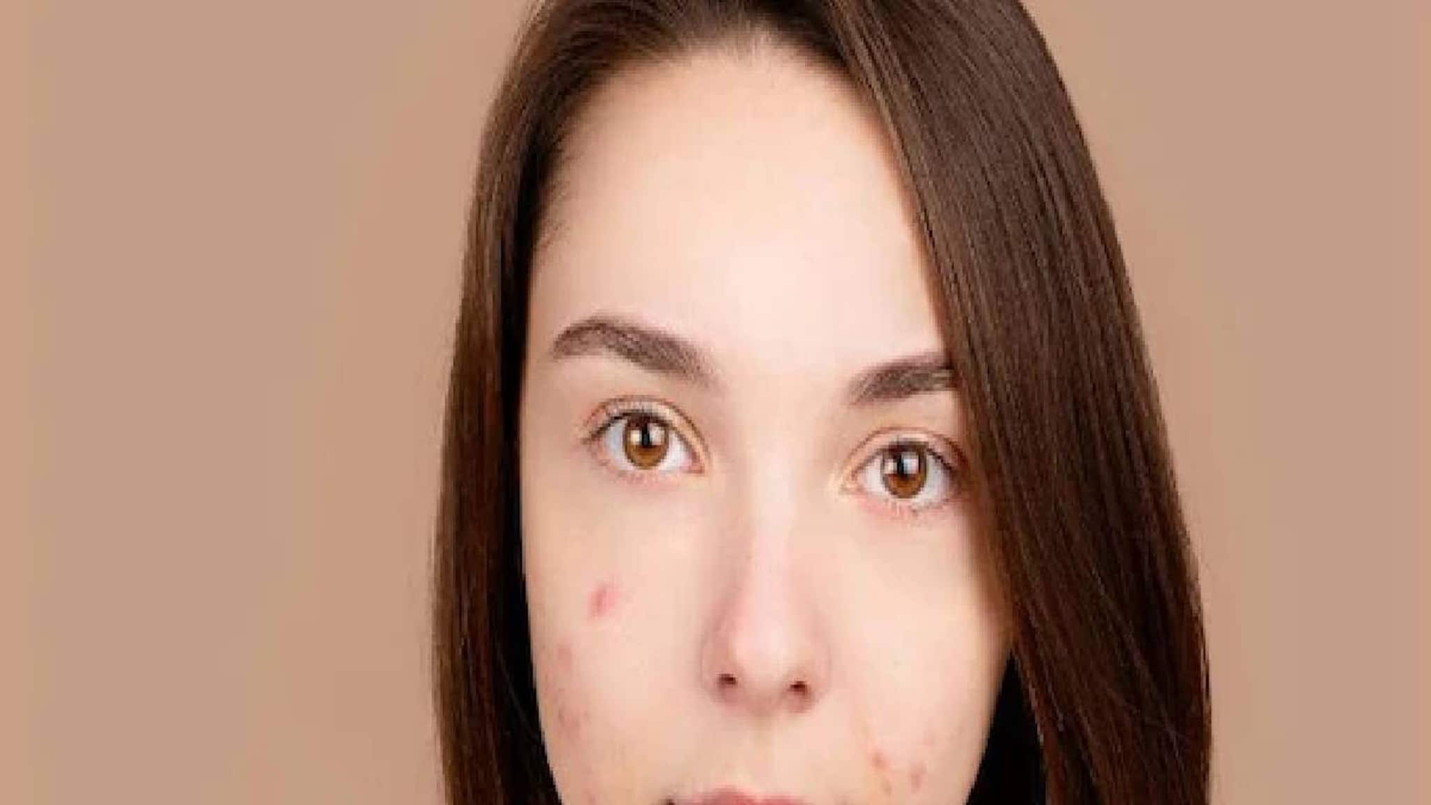 മുഖത്തിന്റെ ഈ ഭാഗത്തെ മുഖക്കുരു പൊട്ടിച്ചു; ചെവിപൊട്ടി, മുഖം വീര്‍ത്ത്, കാഴ്ച മങ്ങിയ യുവതി ചികിത്സ തേടി