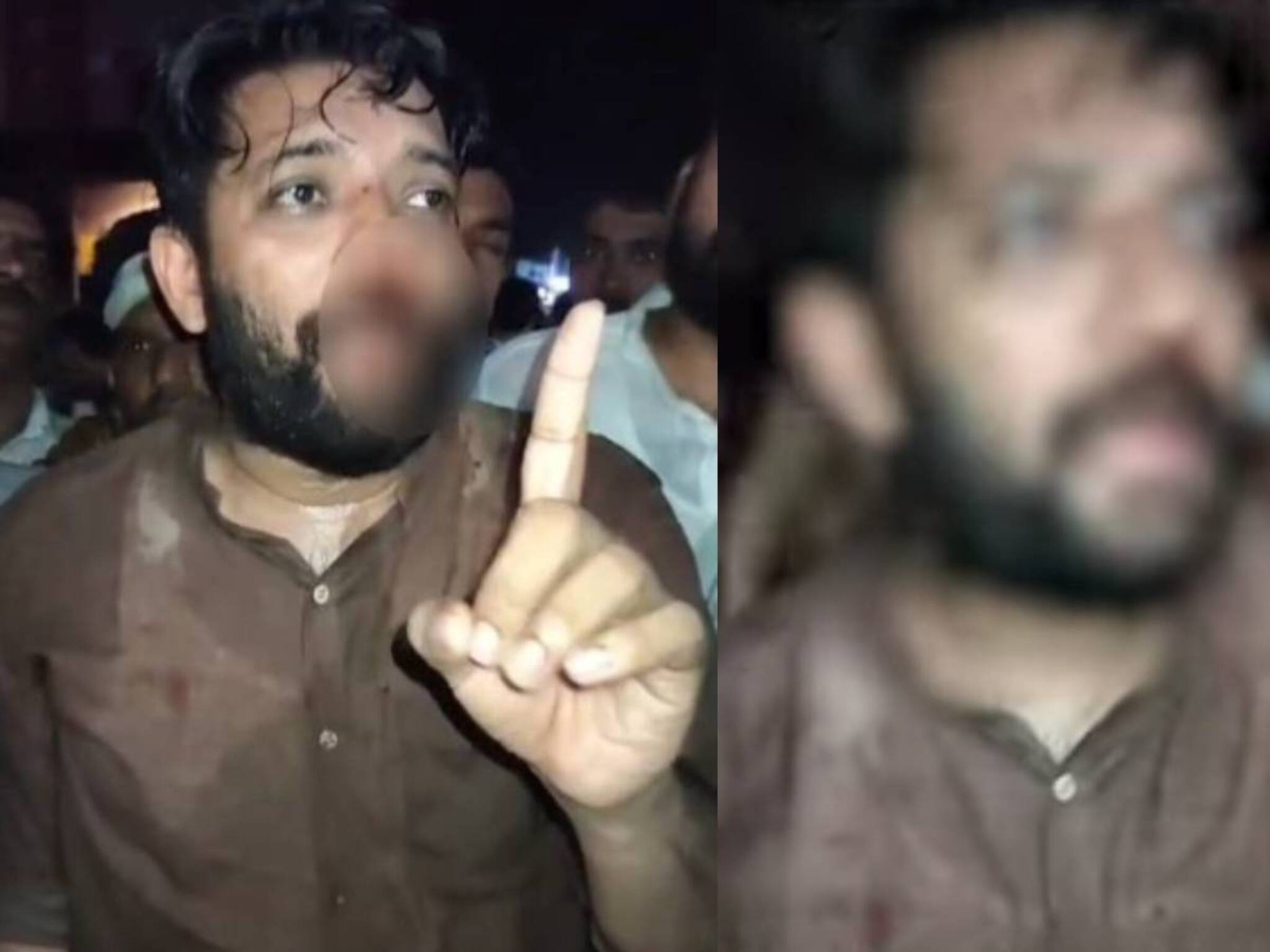 കോഴിക്കോട് സിപിഎം-കോണ്‍ഗ്രസ് സംഘര്‍ഷം; ഷാഫി പറമ്പില്‍ എം.പിക്ക് പരിക്ക്