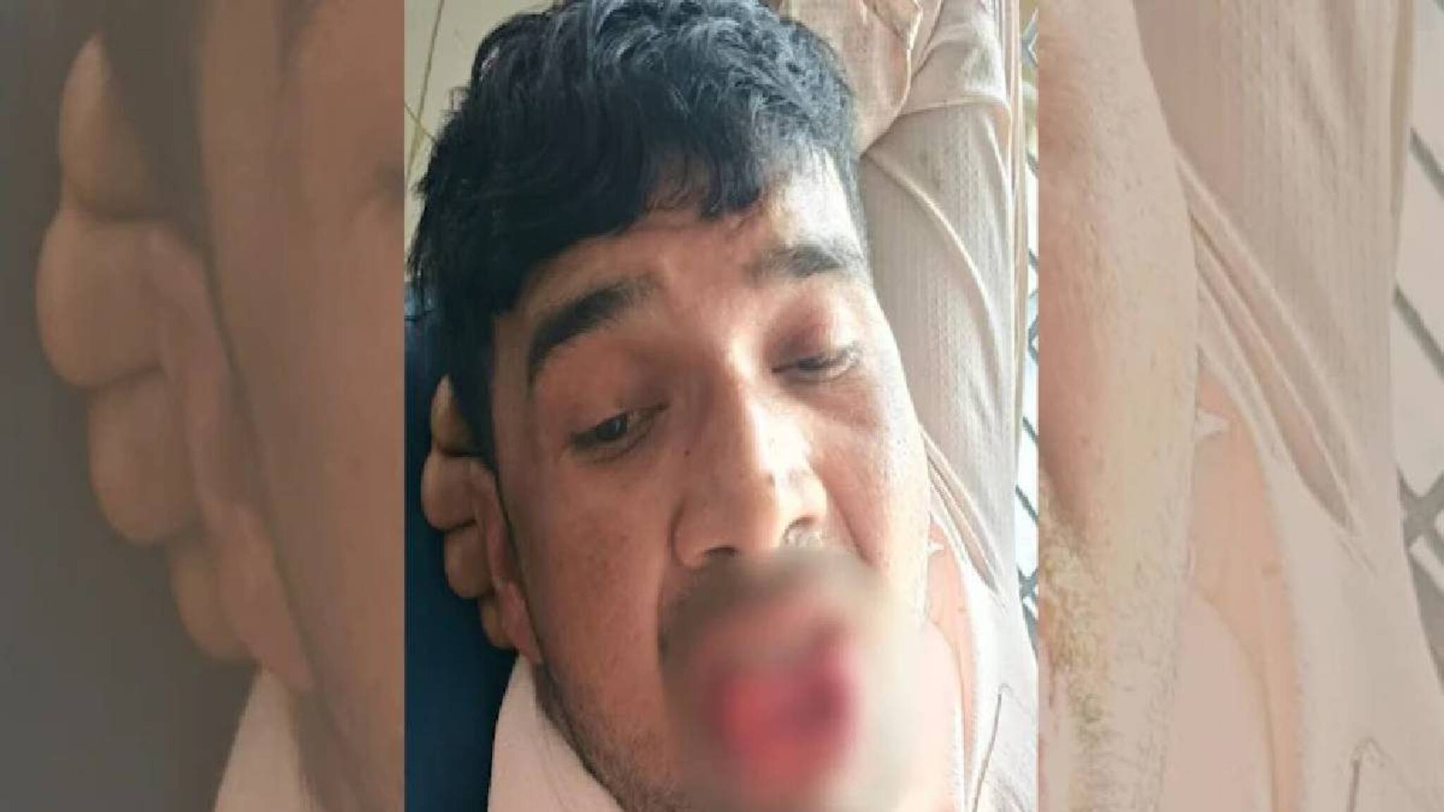 വിവാഹിതനായ കാമുകൻ ചുംബിക്കാൻ ശ്രമിച്ചു; മുൻ കാമുകി  നാക്ക് കടിച്ചു മുറിച്ചു