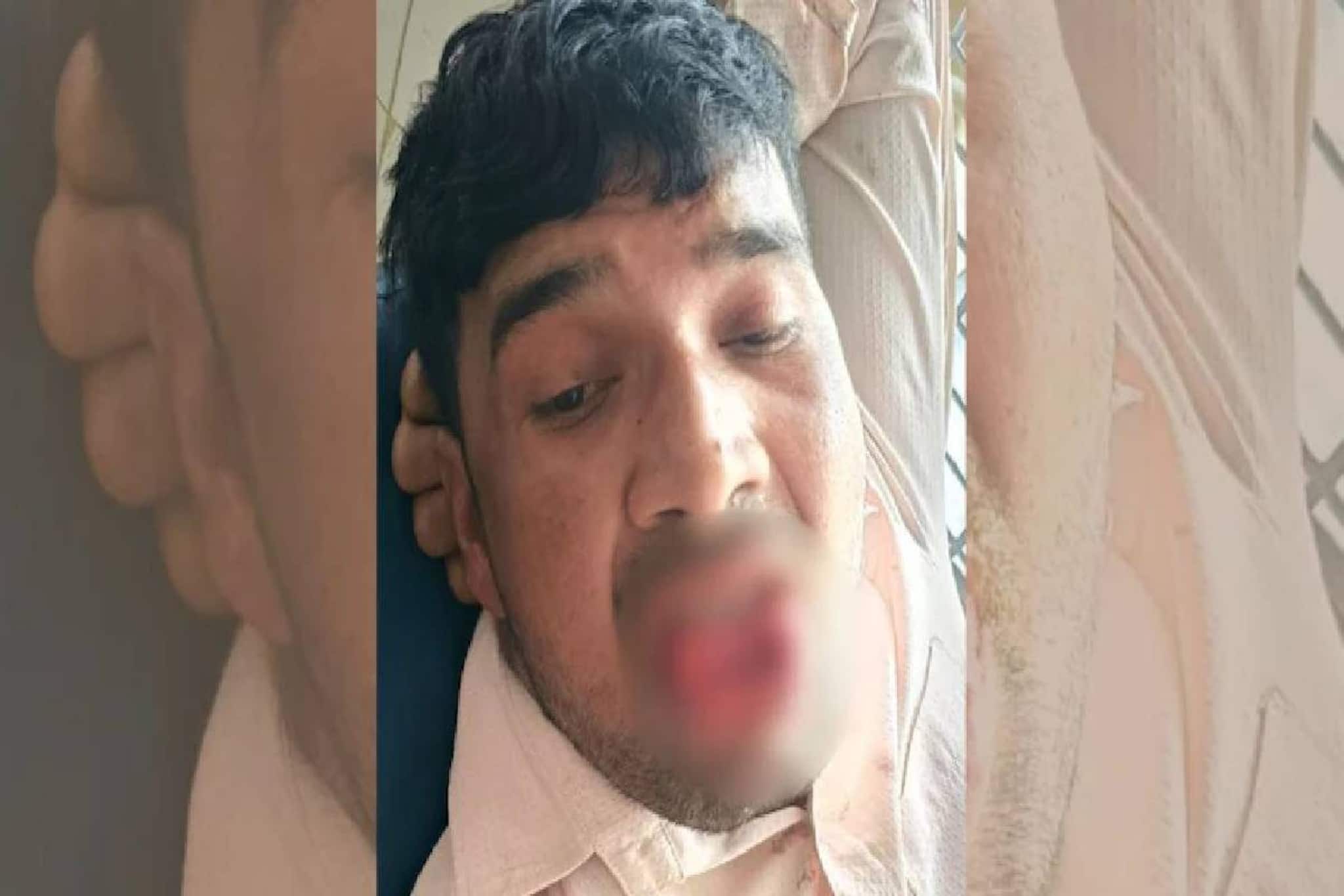 വിവാഹിതനായ കാമുകൻ ചുംബിക്കാൻ ശ്രമിച്ചു; മുൻ കാമുകി  നാക്ക് കടിച്ചു മുറിച്ചു