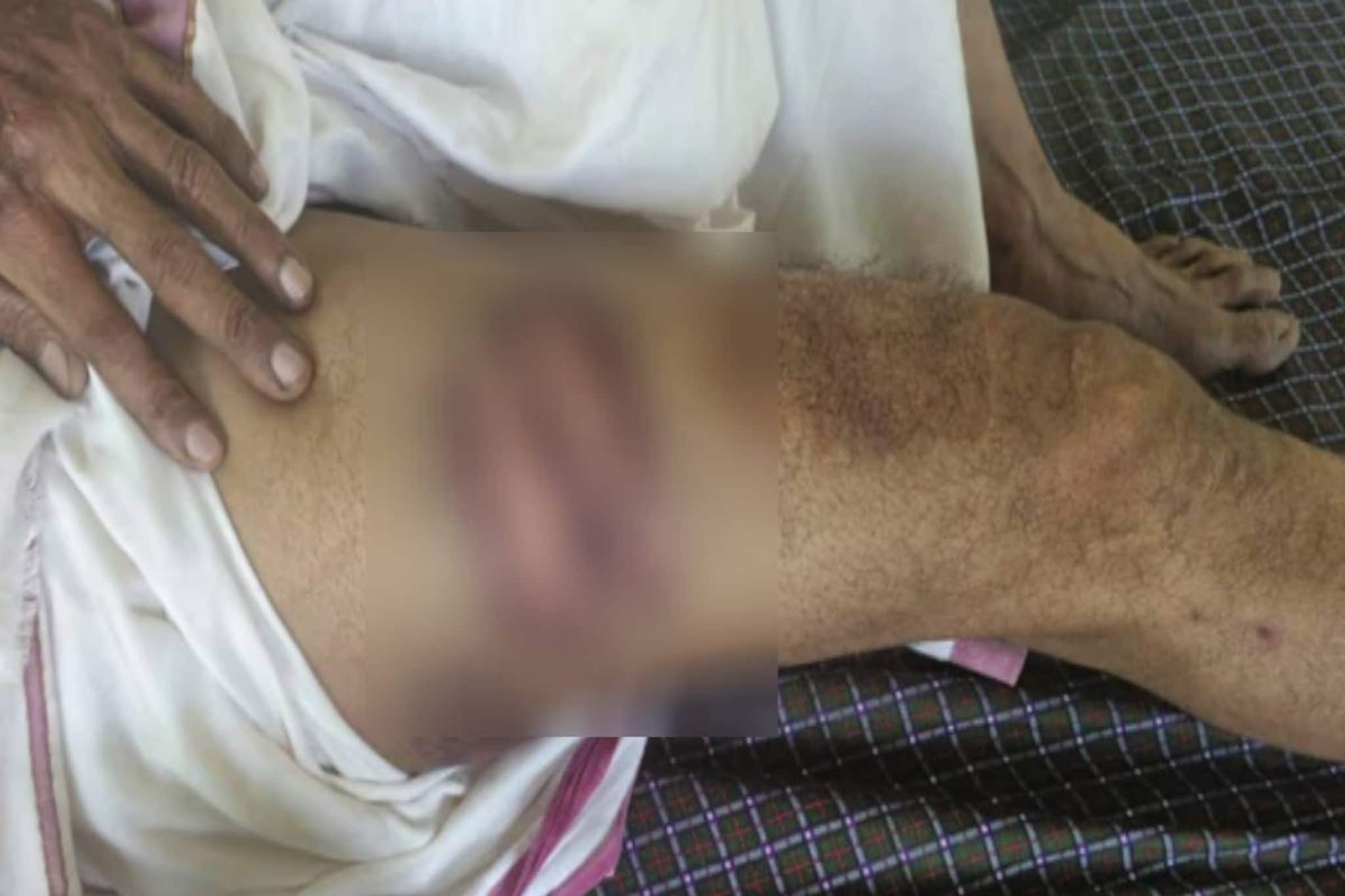 തിരുവനന്തപുരത്ത് ഓട്ടോ ഡ്രൈവർക്ക് പോലീസ് മർദനമെന്ന് പരാതി; വീണതെന്ന് പൊലീസ്: ശരീരമാസകലം ലാത്തിപ്പാടുകൾ