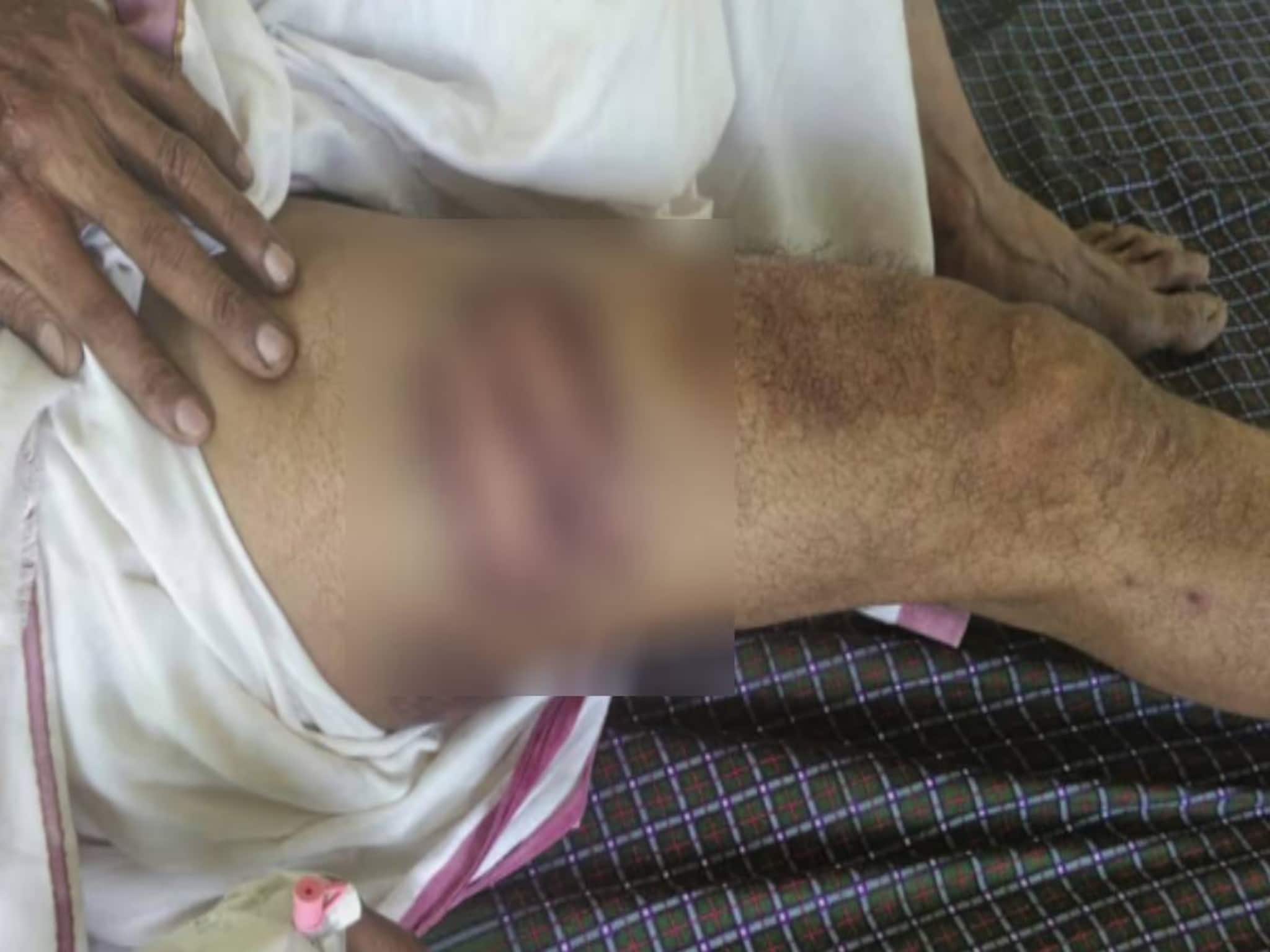 തിരുവനന്തപുരത്ത് ഓട്ടോ ഡ്രൈവർക്ക് പോലീസ് മർദനമെന്ന് പരാതി; വീണതെന്ന് പൊലീസ്: ശരീരമാസകലം ലാത്തിപ്പാടുകൾ