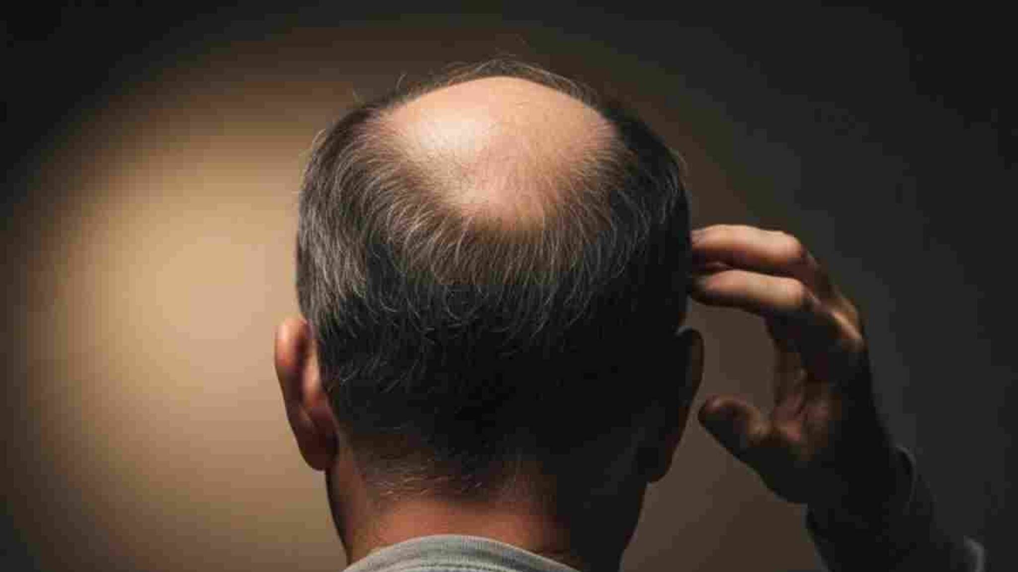 വിവാഹത്തിന് മുൻപ് വരൻ വിഗ്ഗ് വെച്ച് കഷണ്ടി മറച്ചുവെച്ചു, വധു സത്യം അറിഞ്ഞതിന് പിന്നാലെ ഫുൾ വയലൻസ്