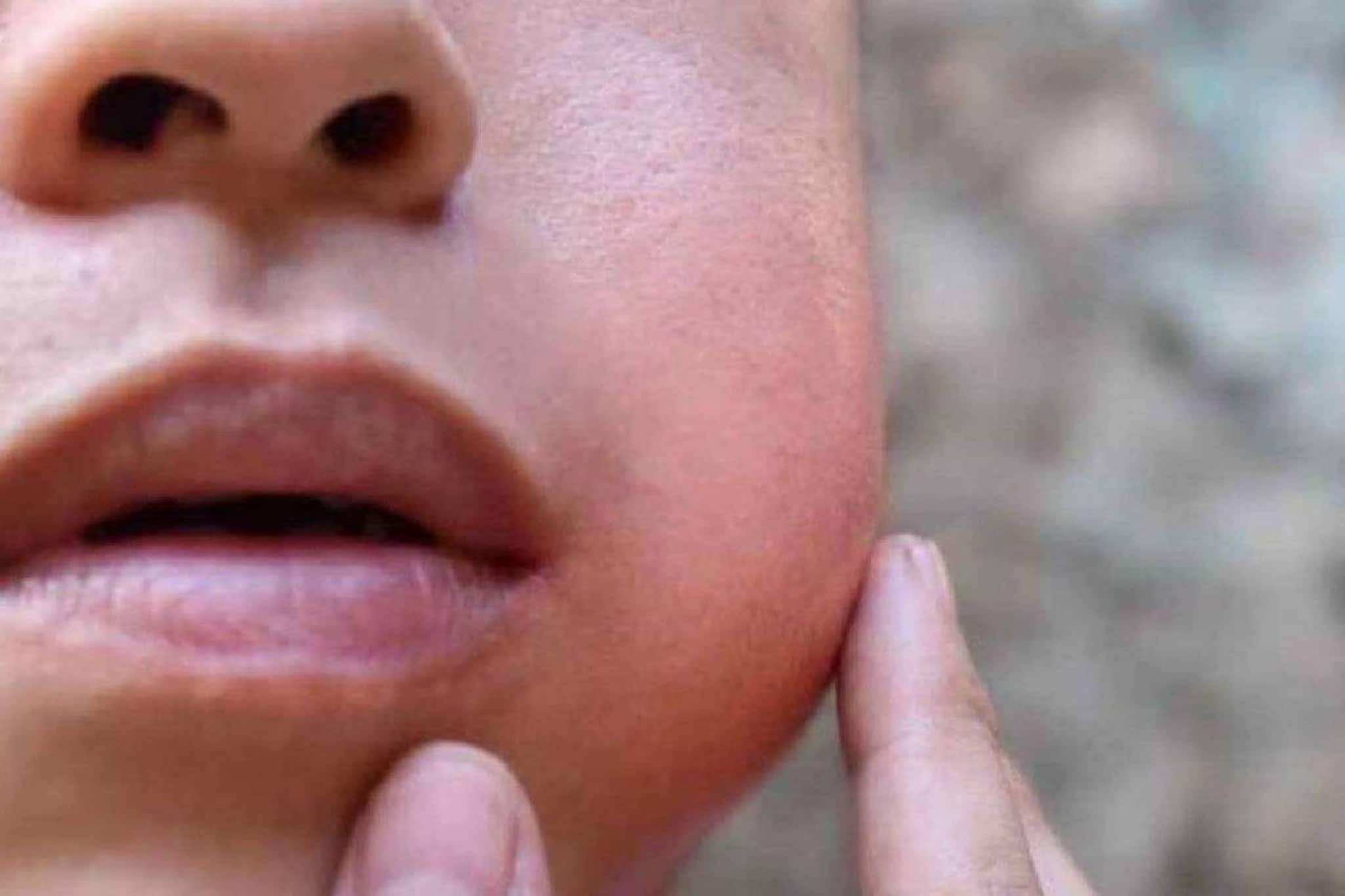 മുണ്ടിനീര് പടരുന്നു: ആലപ്പുഴയിലെ ഒരു സ്കൂളിന് ജില്ലാ കളക്ടർ 21 ദിവസം അവധി പ്രഖ്യാപിച്ചു