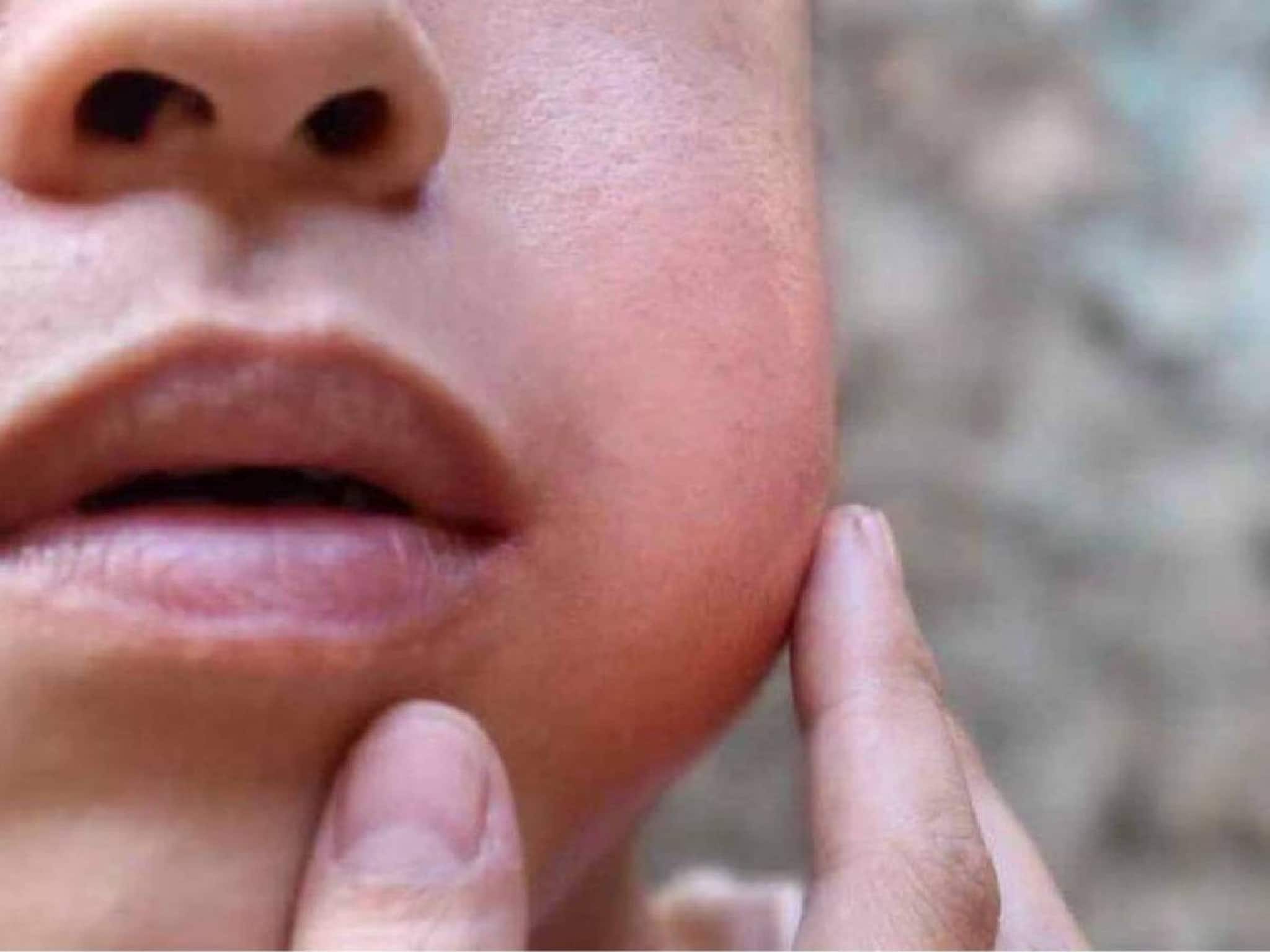 മുണ്ടിനീര് പടരുന്നു: ആലപ്പുഴയിലെ ഒരു സ്കൂളിന് ജില്ലാ കളക്ടർ 21 ദിവസം അവധി പ്രഖ്യാപിച്ചു