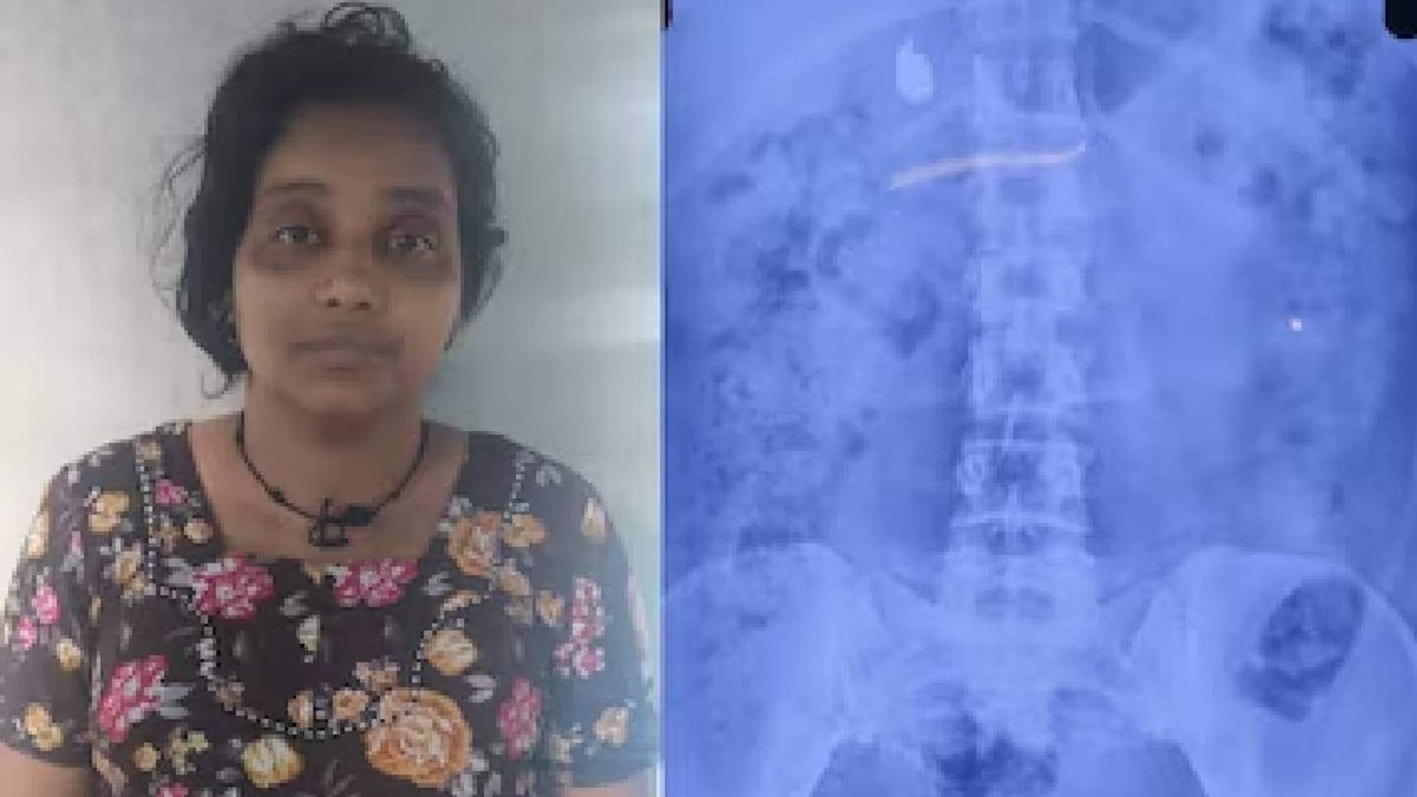 സമീന വിഴുങ്ങിയ സ്വർണമാലയ്ക്കായി പൊലീസിന്റെ കാത്തിരിപ്പ് അഞ്ചാം ദിവസത്തിലേക്ക്;  വയറ്റിൽ ഒരു കമ്മൽ കൂടി