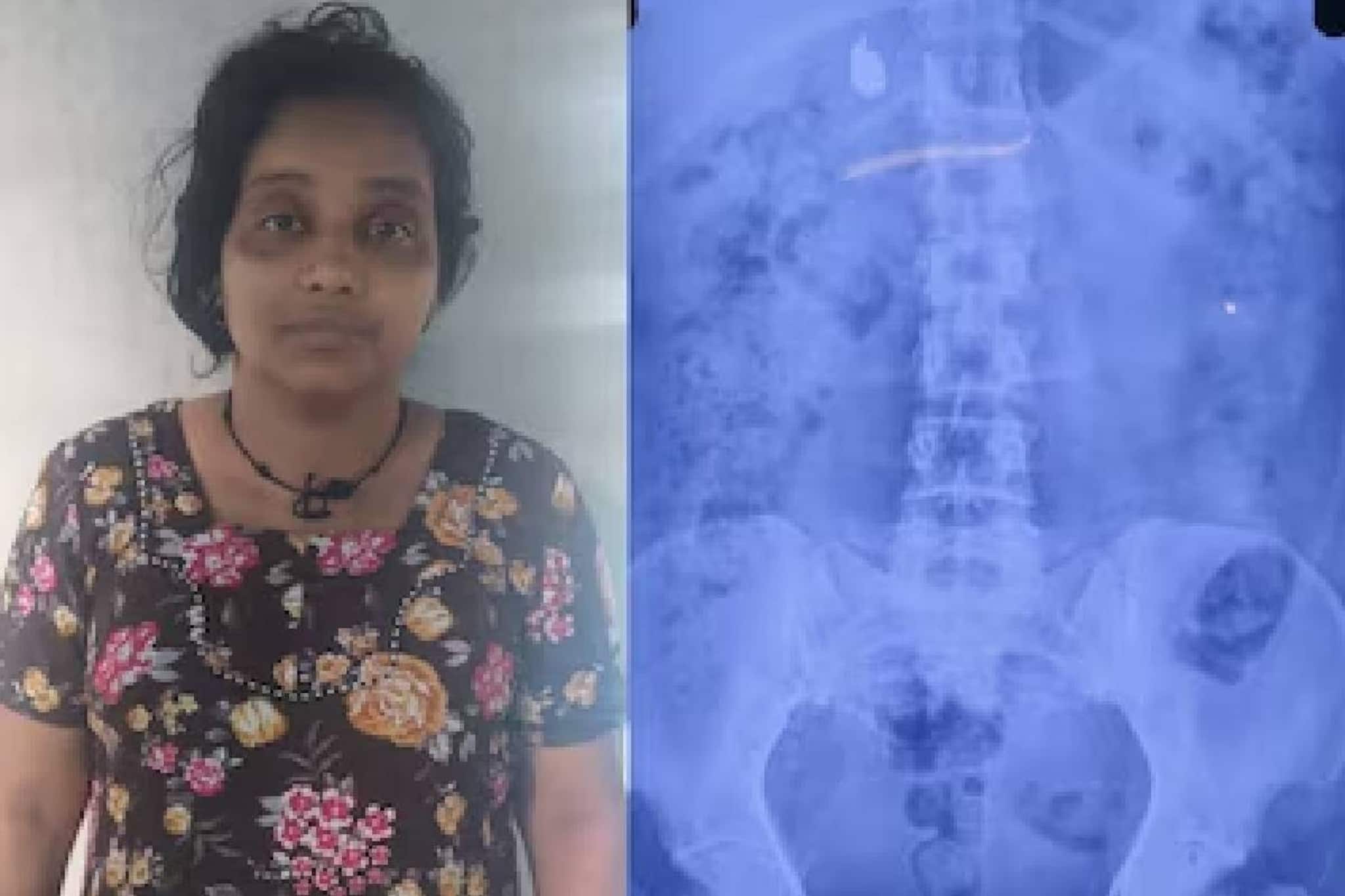 സമീന വിഴുങ്ങിയ സ്വർണമാലയ്ക്കായി പൊലീസിന്റെ കാത്തിരിപ്പ് അഞ്ചാം ദിവസത്തിലേക്ക്; വയറ്റിൽ ഒരു കമ്മൽ കൂടി സമീന വിഴുങ്ങിയ സ്വർണമാലയ്ക്കായി പൊലീസിന്റെ കാത്തിരിപ്പ് അഞ്ചാം ദിവസത്തിലേക്ക്; വയറ്റിൽ ഒരു കമ്മൽ കൂടി