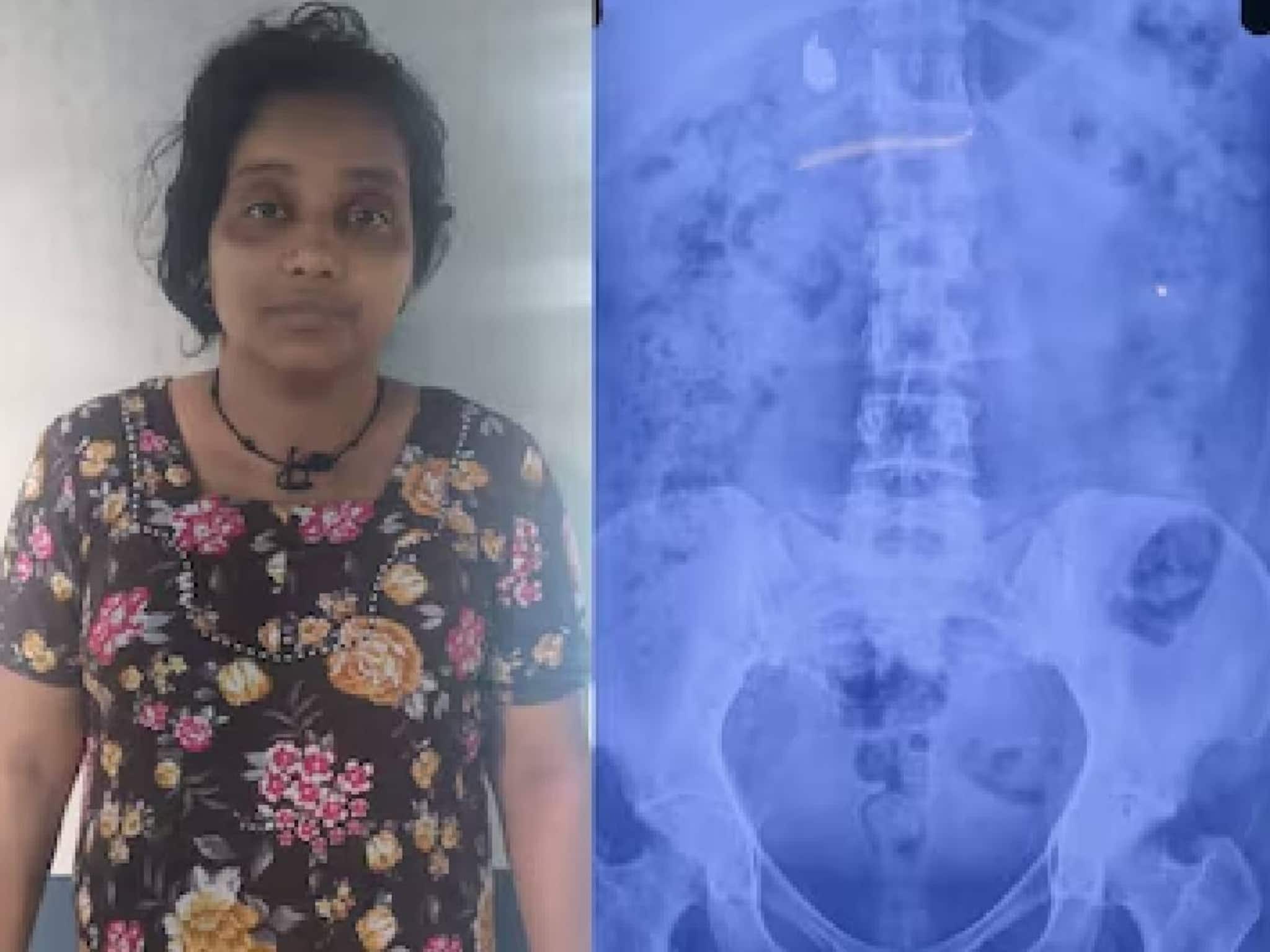 സമീന വിഴുങ്ങിയ സ്വർണമാലയ്ക്കായി പൊലീസിന്റെ കാത്തിരിപ്പ് അഞ്ചാം ദിവസത്തിലേക്ക്; വയറ്റിൽ ഒരു കമ്മൽ കൂടി സമീന വിഴുങ്ങിയ സ്വർണമാലയ്ക്കായി പൊലീസിന്റെ കാത്തിരിപ്പ് അഞ്ചാം ദിവസത്തിലേക്ക്; വയറ്റിൽ ഒരു കമ്മൽ കൂടി