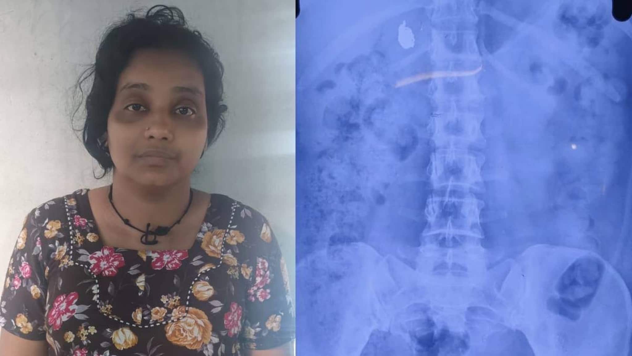 കുട്ടിയെ ഓമനിച്ച് സ്വർണമാല കട്ടെടുത്ത് യുവതി വിഴുങ്ങി; 'തൊണ്ടിമുതൽ' പുറത്തുവരാൻ പോലീസിന്റെ കാത്തിരിപ്പ്