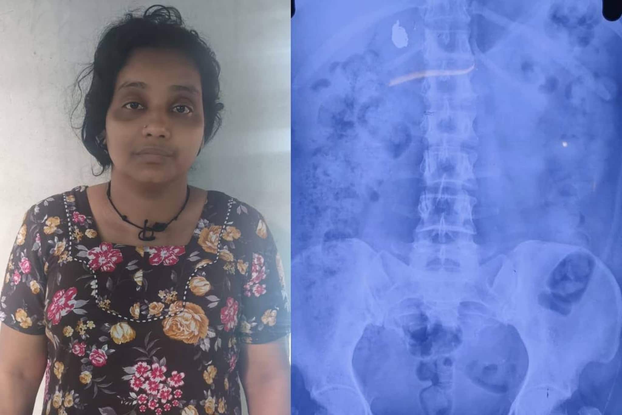 കുട്ടിയെ ഓമനിച്ച് സ്വർണമാല കട്ടെടുത്ത് യുവതി വിഴുങ്ങി; 'തൊണ്ടിമുതൽ' പുറത്തുവരാൻ പോലീസിന്റെ കാത്തിരിപ്പ്