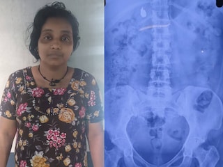 യുവതിയും എക്സ്റേ പരിശോധനാ ഫലവും