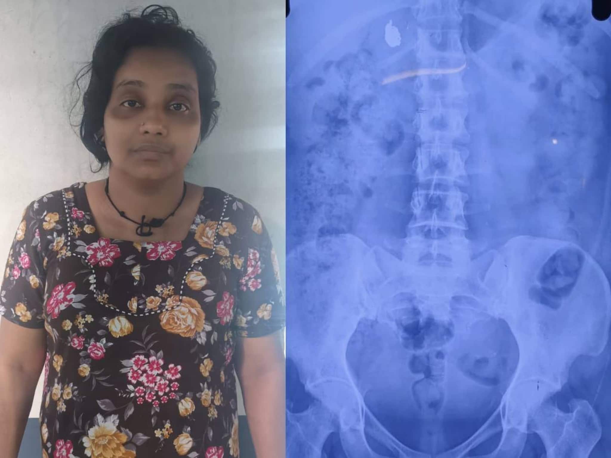 യുവതി കുട്ടിയുടെ സ്വർണമാല മോഷ്ടിച്ച് വിഴുങ്ങി; 'തൊണ്ടിമുതൽ' പുറത്തുവരാൻ പോലീസിന്റെ കാത്തിരിപ്പ്