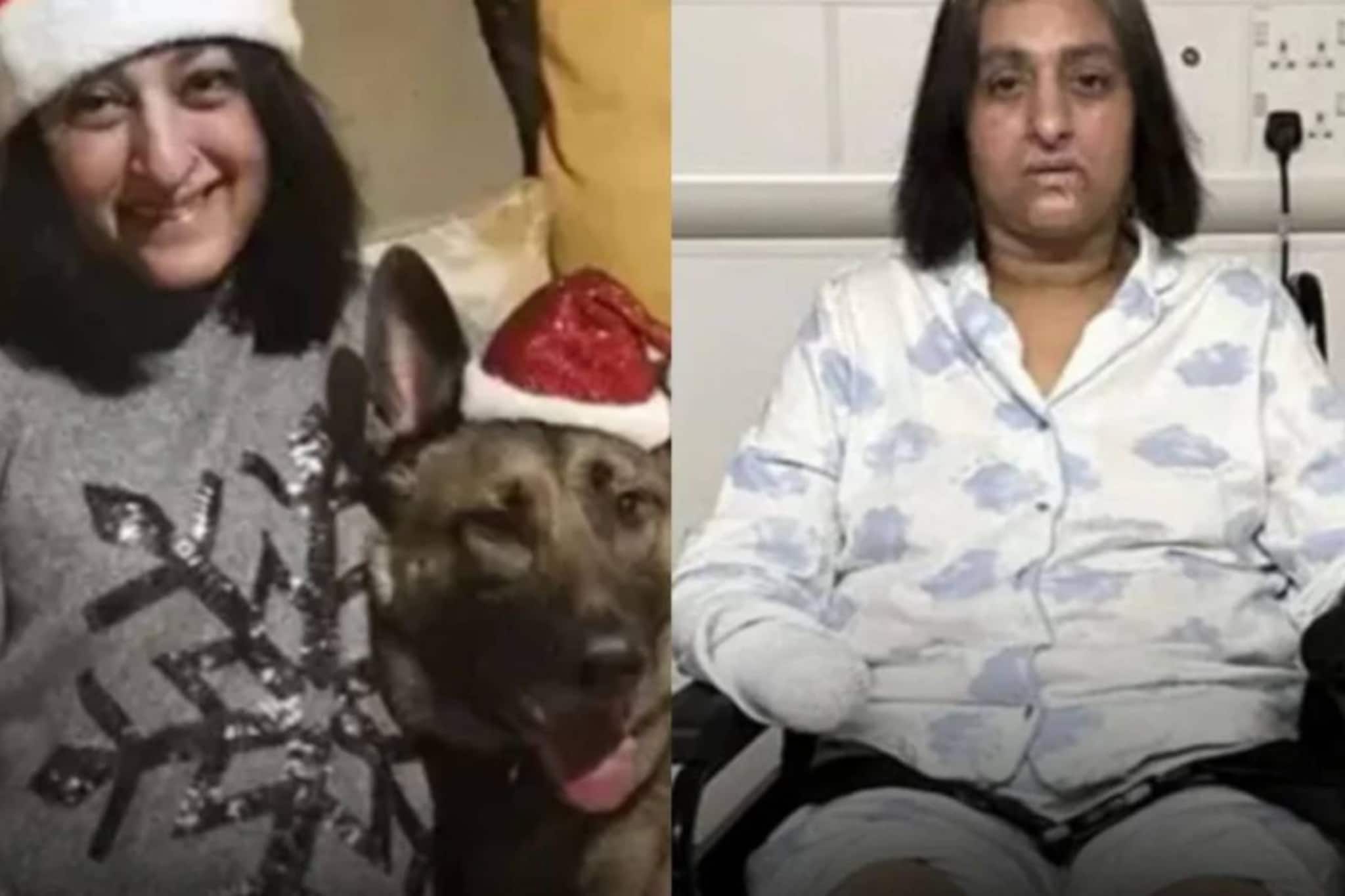 യുവതിയുടെ ചെറിയ മുറിവിൽ നായ നക്കി; കൈയും കാലും നഷ്ടമായി; സെപ്സിസിനെതിരെ കരുതൽ വേണം