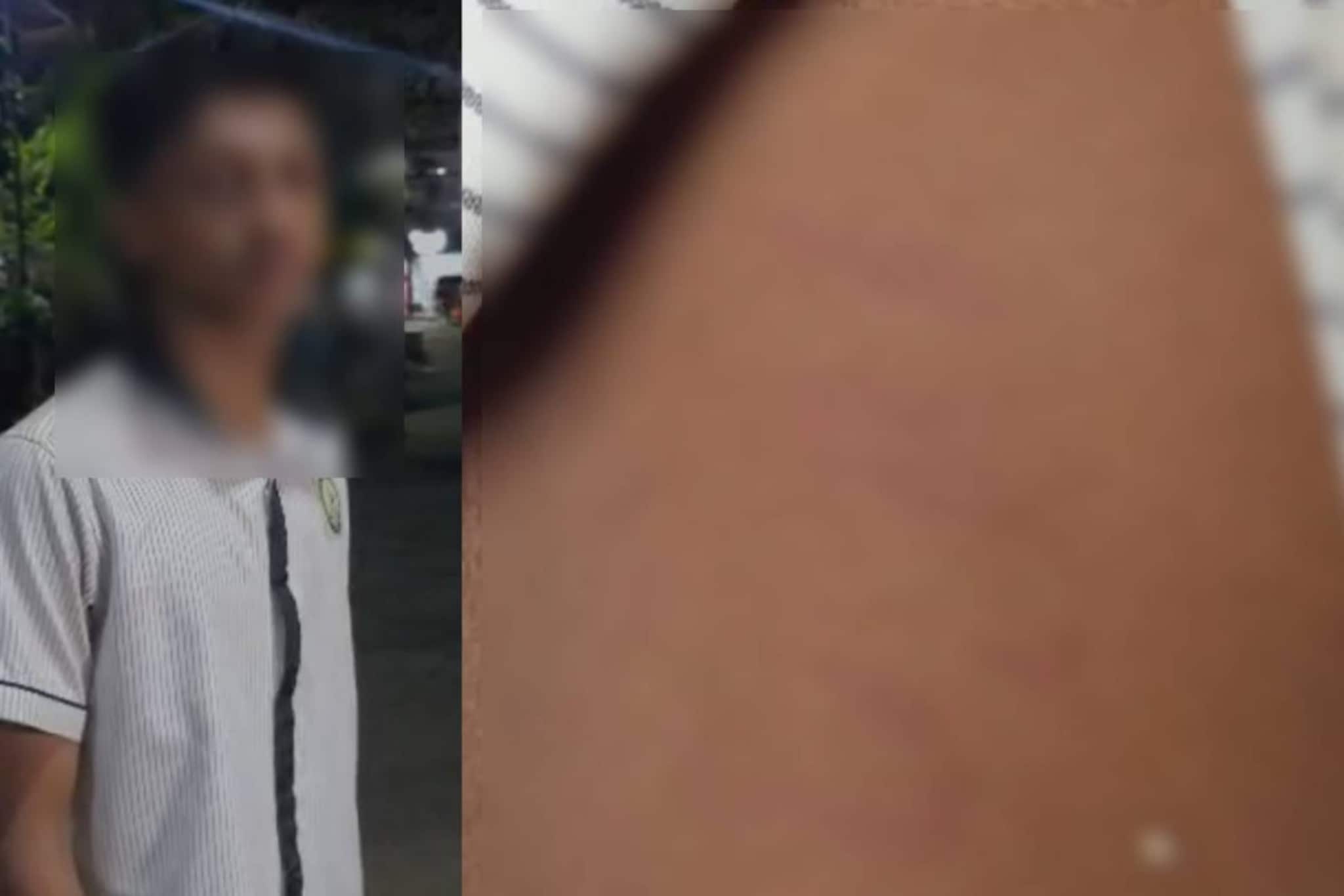 ചെരുപ്പും ഹെയർ സ്റ്റൈലും ഇഷ്ടപ്പെട്ടില്ല; കോഴിക്കോട് എട്ടാം ക്ലാസുകാരനെ 15ഓളം സീനിയർ വിദ്യാർത്ഥികൾ ക്രൂരമായി മർദിച്ചതായി പരാതി