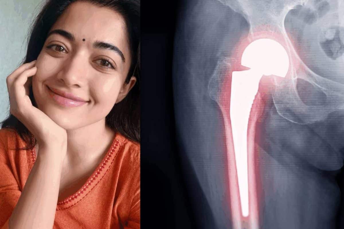 ഇടുപ്പെല്ലിലെ പരിക്കിനെക്കുറിച്ച് രശ്മിക മന്ദാന: എന്താണ് ടെൻഡൺ വേർപെടൽ?