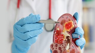 किडनी विकारांच्या रुग्णांच वाढतंय प्रमाण, 'ही' आहेत प्रमुख कारणं किडनी विकारांच्या रुग्णांच वाढतंय प्रमाण, 'ही' आहेत प्रमुख कारणं