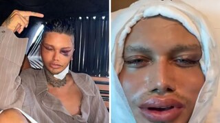 बोर झालं म्हणून चेहऱ्याची सर्जरी, 52 लाख केले खर्च