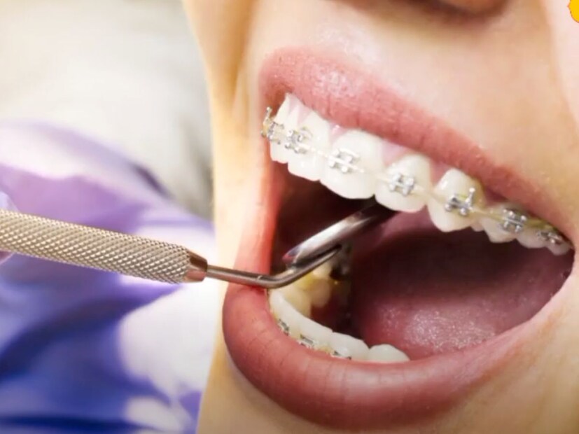 दातांचे दुखणे कोणालाही सहन होत नाही. दात दुखण्याची तसंच दात किडण्याची समस्या मोठ्यांसह लहान मुलांमध्येही दिसून येते. विशेषतः आजकाल 18 वर्षांच्या आत असलेल्या मुलांमध्येसुद्धा दातांच्या समस्या दिसून येतात. त्यावर सिमेंट भरणे किंवा रूट कॅनल सारख्या ट्रीटमेंट सुद्धा डॉक्टरांना कराव्या लागतात. दातांचे दुखणे कोणालाही सहन होत नाही. दात दुखण्याची तसंच दात किडण्याची समस्या मोठ्यांसह लहान मुलांमध्येही दिसून येते. विशेषतः आजकाल 18 वर्षांच्या आत असलेल्या मुलांमध्येसुद्धा दातांच्या समस्या दिसून येतात. त्यावर सिमेंट भरणे किंवा रूट कॅनल सारख्या ट्रीटमेंट सुद्धा डॉक्टरांना कराव्या लागतात.