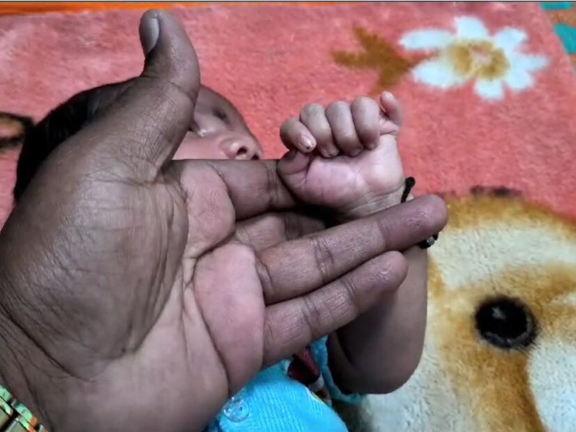 म्हणजेच प्रत्येक हाताला आणि पायाला प्रत्येकी एक बोट अधिक आहे. दरम्यान जन्मलेलं बाळ आणि बाळाची आई दोघेही सुखरूप आहेत.